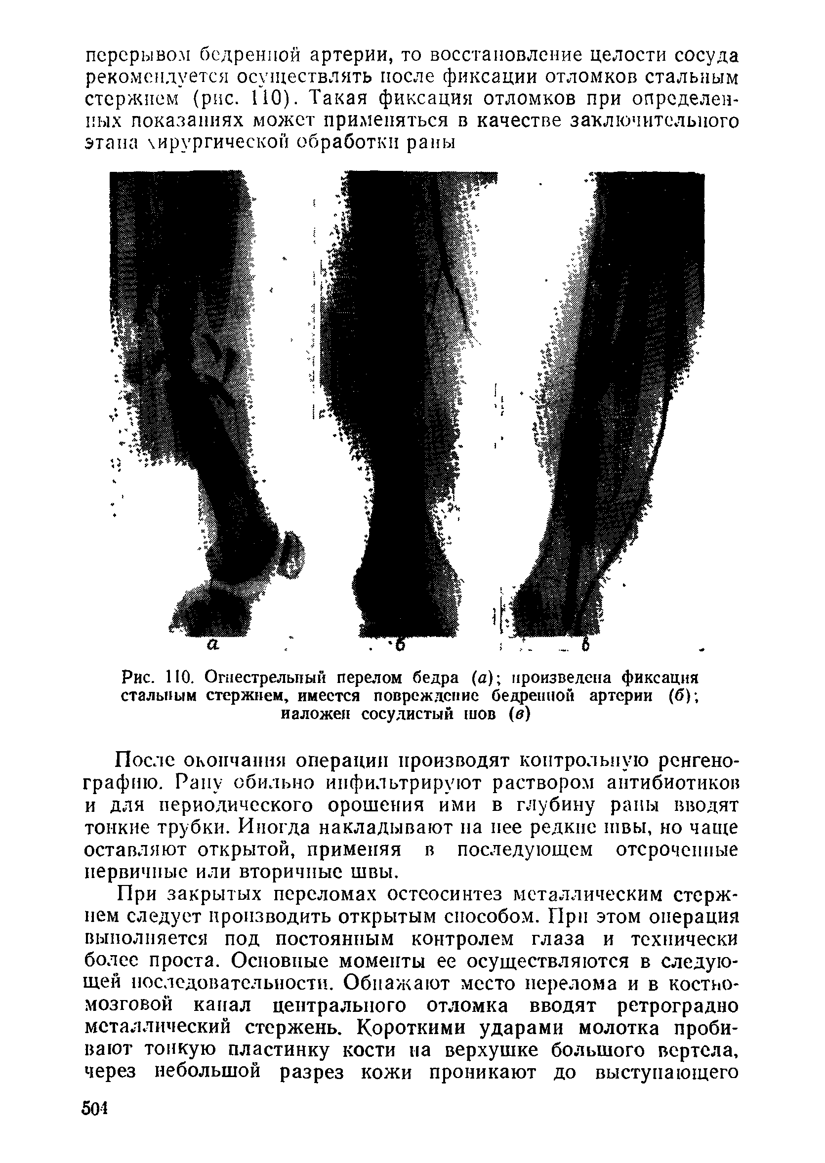 Рис. 110. Огнестрельный перелом бедра (а) произведена фиксация стальным стержнем, имеется повреждение бедренной артерии (б) наложен сосудистый шов (в)...