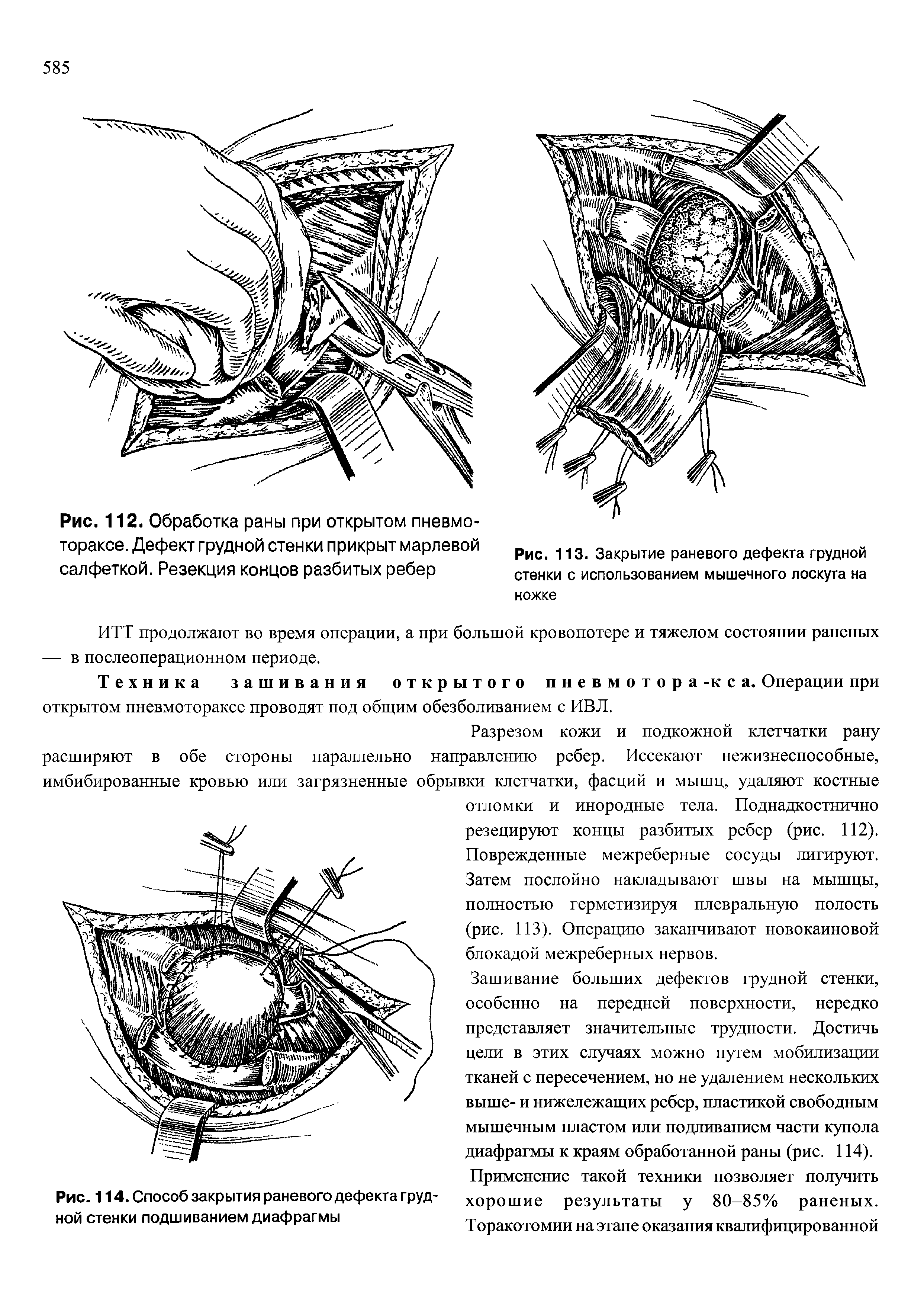 Рис. 114. Способ закрытия раневого дефекта грудной стенки подшиванием диафрагмы...