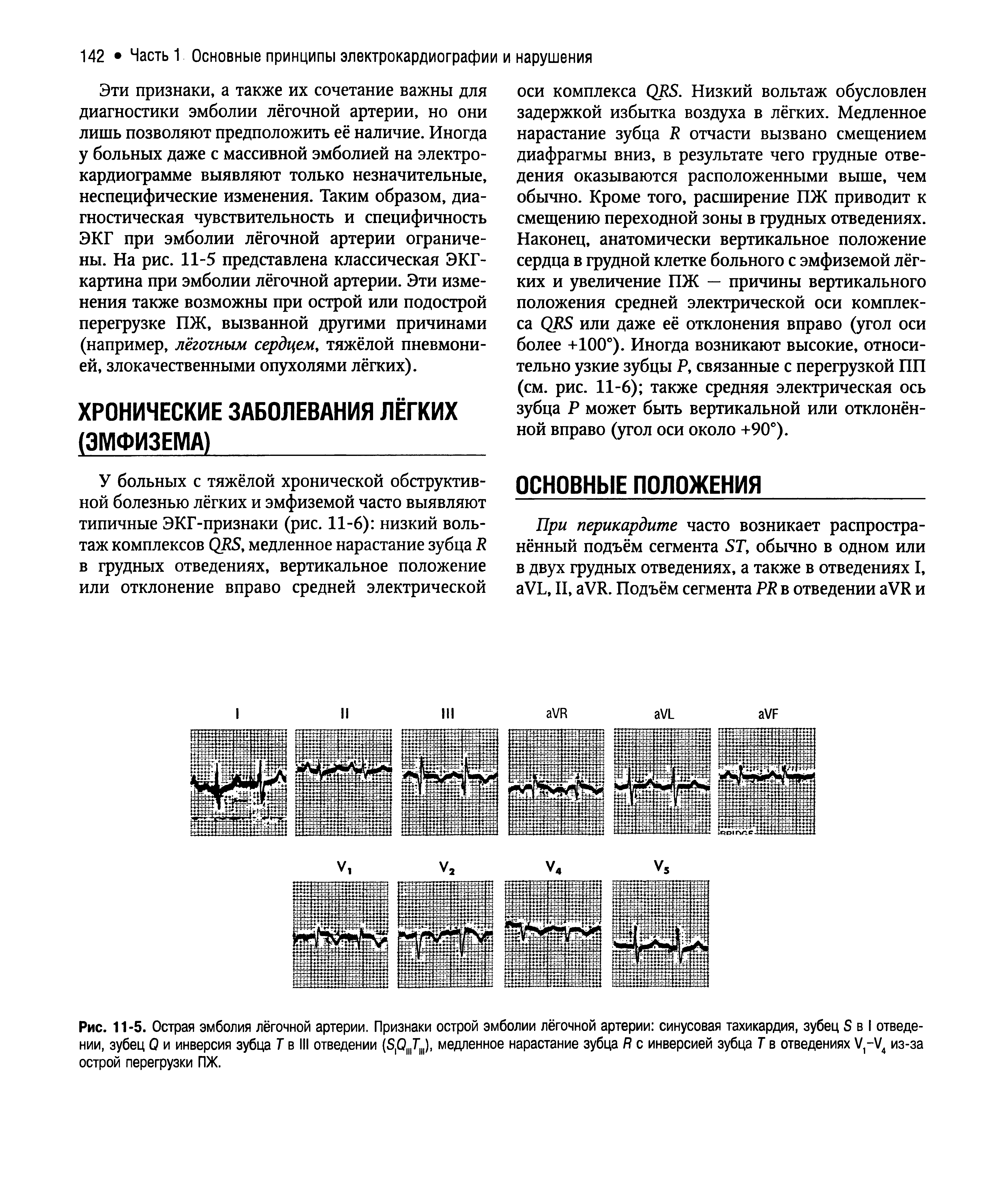 Рис. 11-5. Острая эмболия лёгочной артерии. Признаки острой эмболии лёгочной артерии синусовая тахикардия, зубец S в I отведении, зубец Q и инверсия зубца Т в III отведении (ЗДЛ,), медленное нарастание зубца R с инверсией зубца Т в отведениях V-V4 из-за острой перегрузки ПЖ.