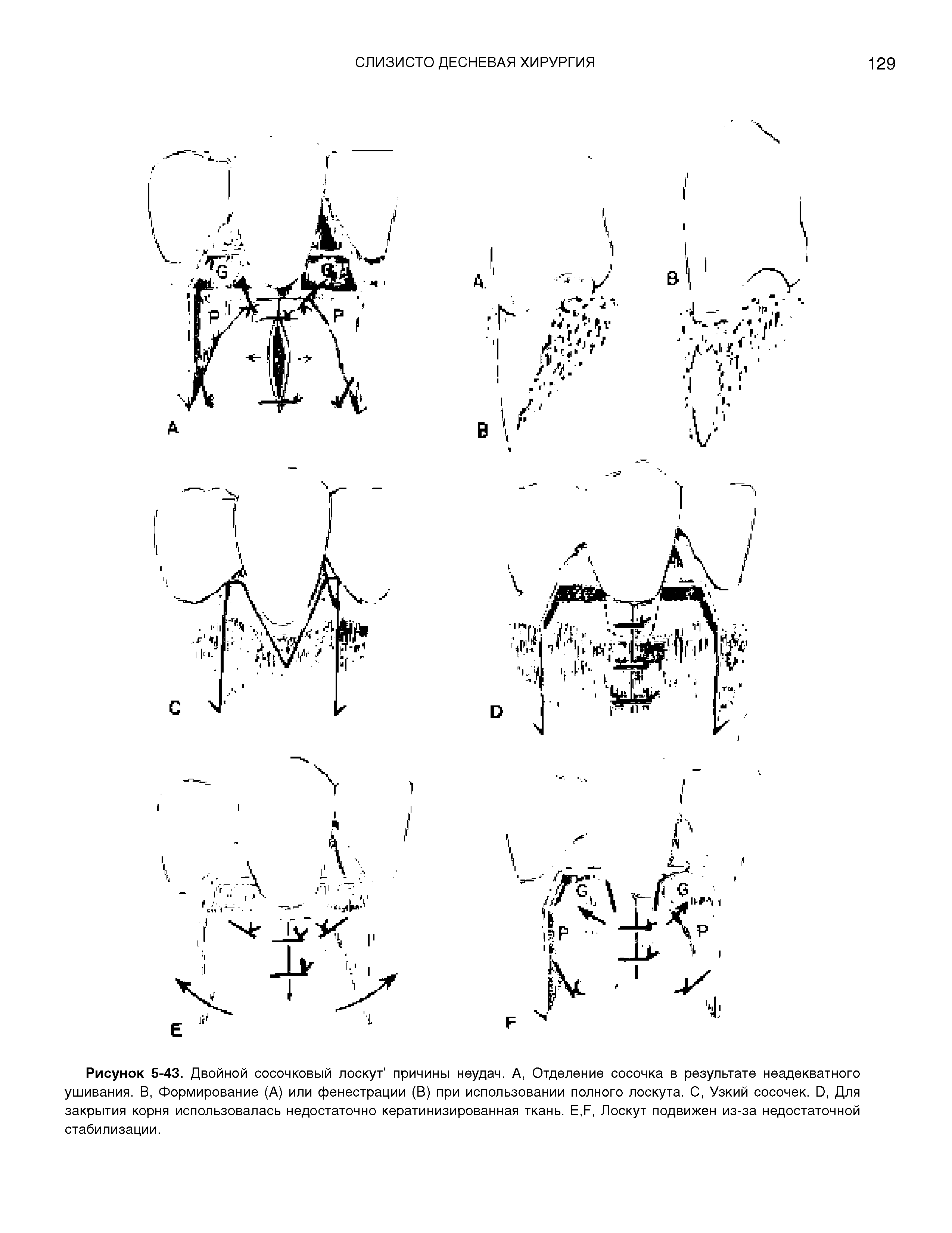 Рисунок 5-43. Двойной сосочковый лоскут причины неудач. А, Отделение сосочка в результате неадекватного ушивания. В, Формирование (А) или фенестрации (В) при использовании полного лоскута. С, Узкий сосочек. О, Для закрытия корня использовалась недостаточно кератинизированная ткань. Е,Л, Лоскут подвижен из-за недостаточной стабилизации.