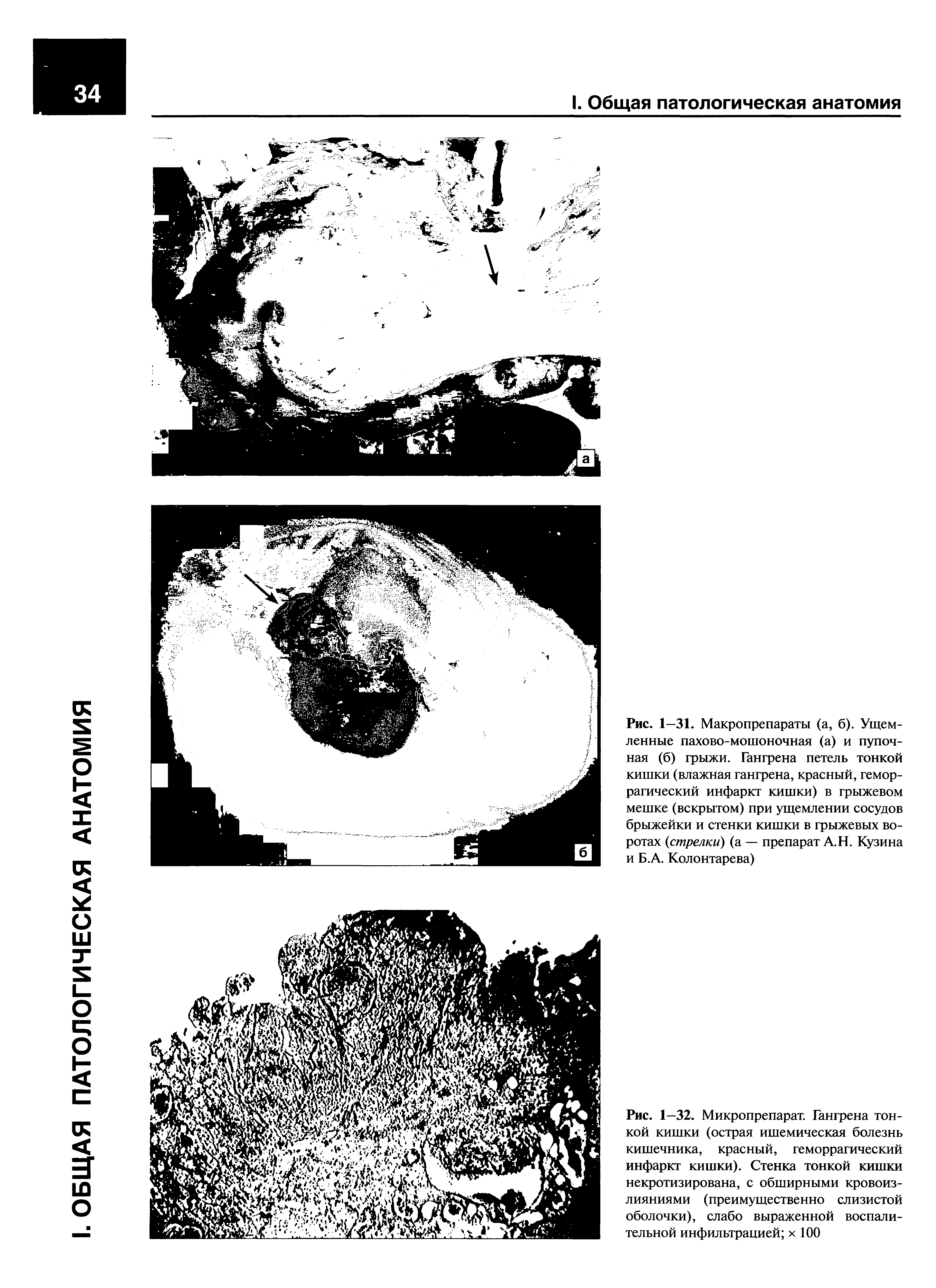 Рис. 1—32. Микропрепарат. Гангрена тонкой кишки (острая ишемическая болезнь кишечника, красный, геморрагический инфаркт кишки). Стенка тонкой кишки некротизирована, с обширными кровоизлияниями (преимущественно слизистой оболочки), слабо выраженной воспалительной инфильтрацией х 100...