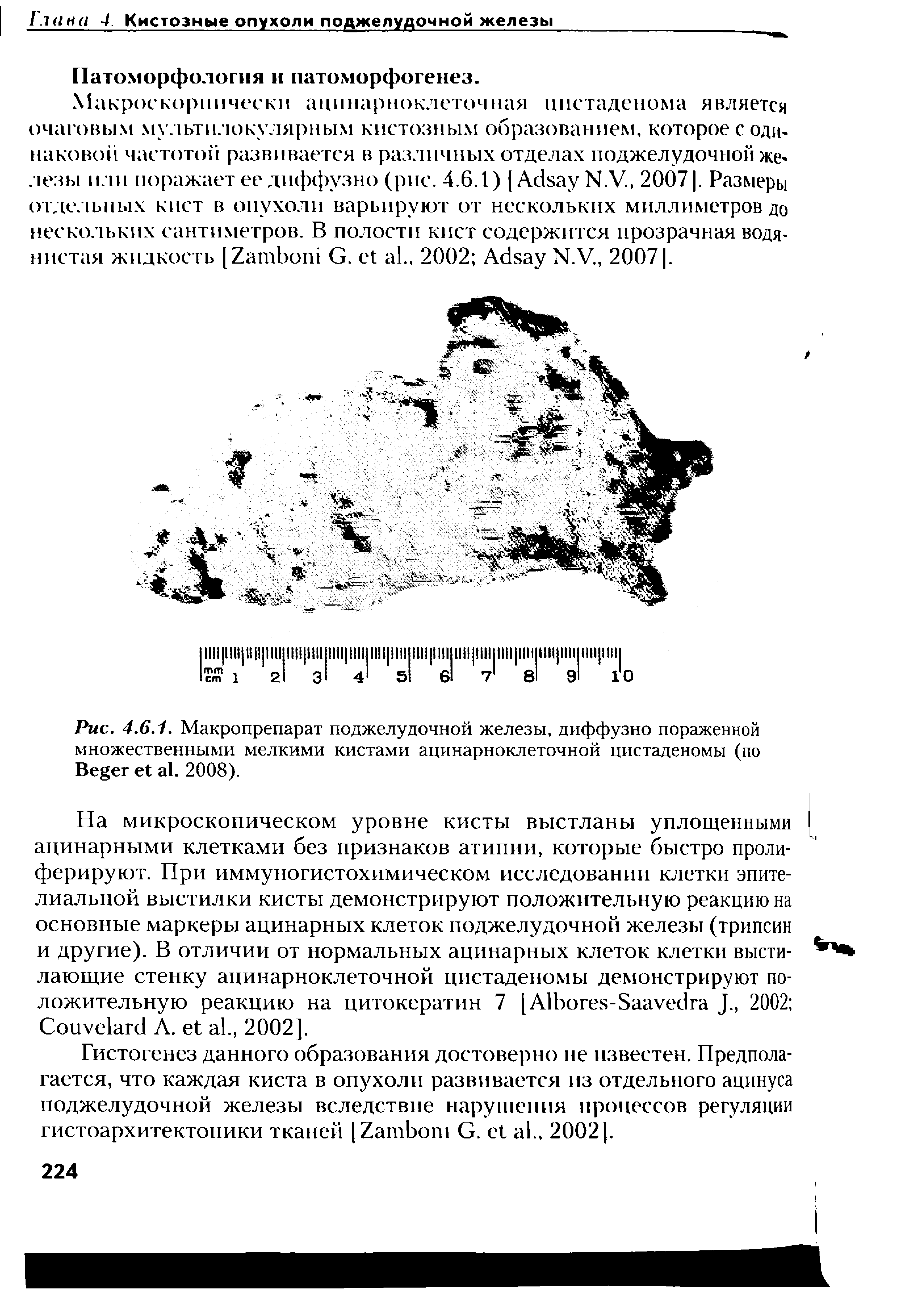 Рис. 4.6.1. Макропрепарат поджелудочной железы, диффузно пораженной множественными мелкими кистами ацинарноклеточной цистаденомы (по B . 2008).