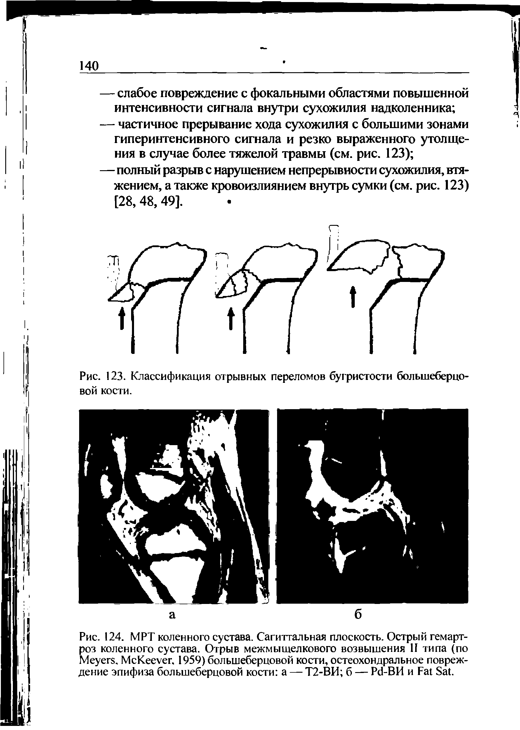 Рис. 124. МРТ коленного сустава. Сагиттальная плоскость. Острый гемартроз коленного сустава. Отрыв межмыщелкового возвышения II типа (по M . M K . 1959) большеберцовой кости, остеохондральное повреждение эпифиза большеберцовой кости а — Т2-ВИ б — P -ВИ и F S .