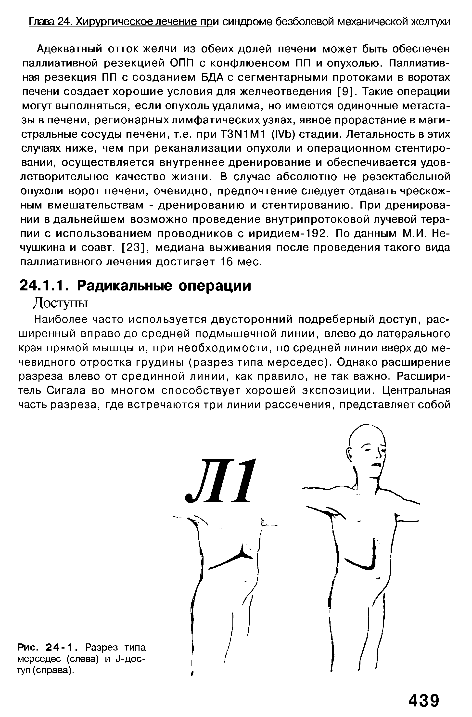 Рис. 24-1. Разрез типа мерседес (слева) и и-доступ (справа).