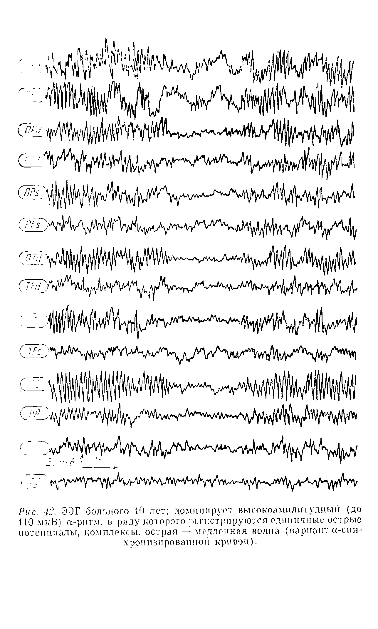 Рис. 42. ЭЭГ больного 10 лет доминирует высокоамплитудный (до 110 мкВ) а.-ритм, в ряду которого регистрируются единичные острые потенциалы, комплексы, острая — медленная волна (вариант -синхронизированной кривой).
