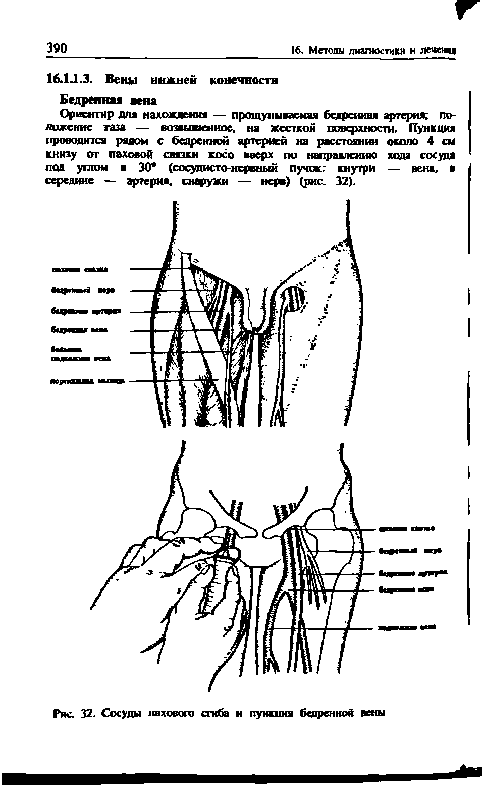 Рис. 32. Сосуды пахового сгиба и пункция бедренной вены...