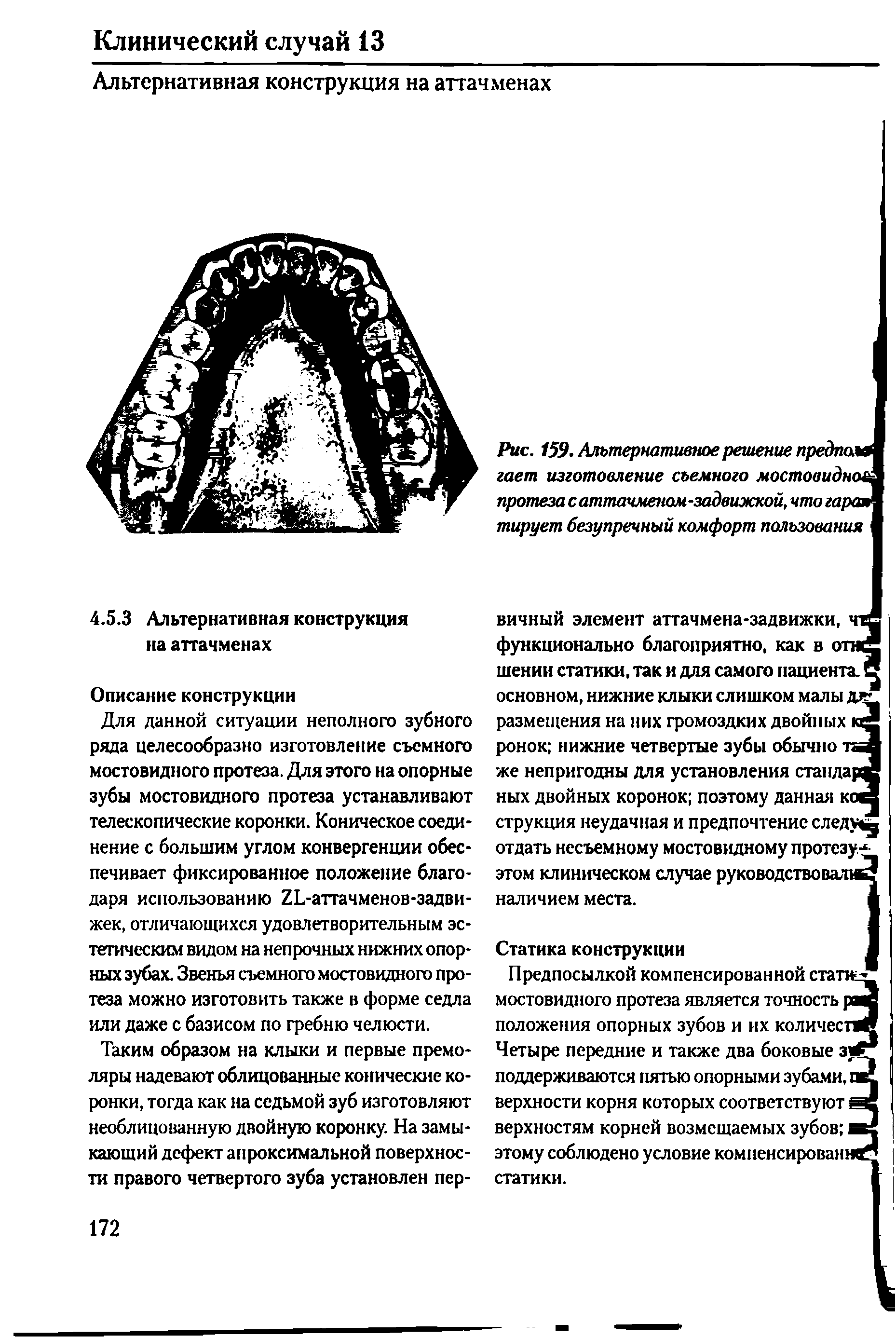 Рис. 159. Альтернативное решение предполЛ гает изготовление съемного мостовидное протеза саттачменом-задвижкой, что гарая тирует безупречный комфорт пользования...