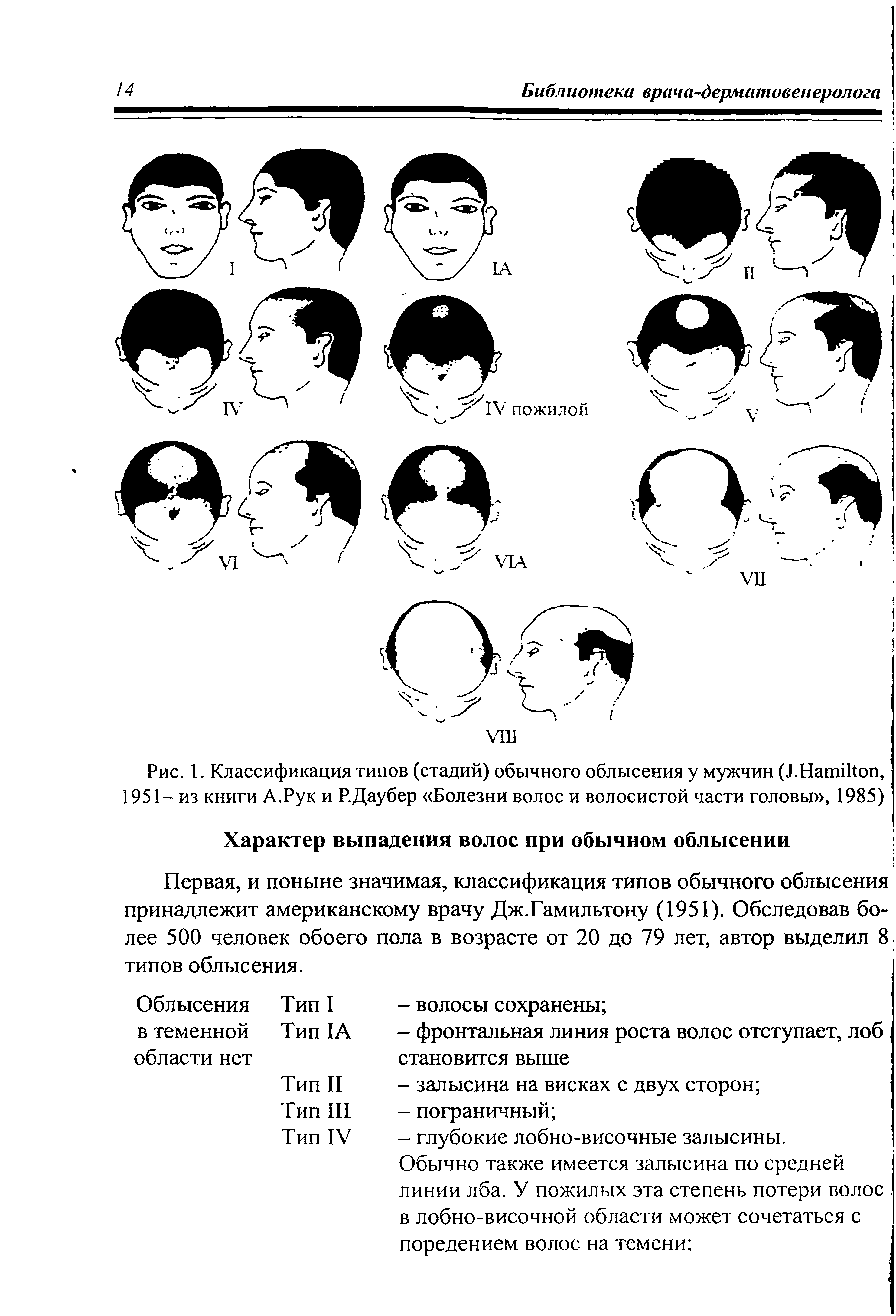 Рис. 1. Классификация типов (стадий) обычного облысения у мужчин (J.H , 1951- из книги А.Рук и Р.Даубер Болезни волос и волосистой части головы , 1985)...