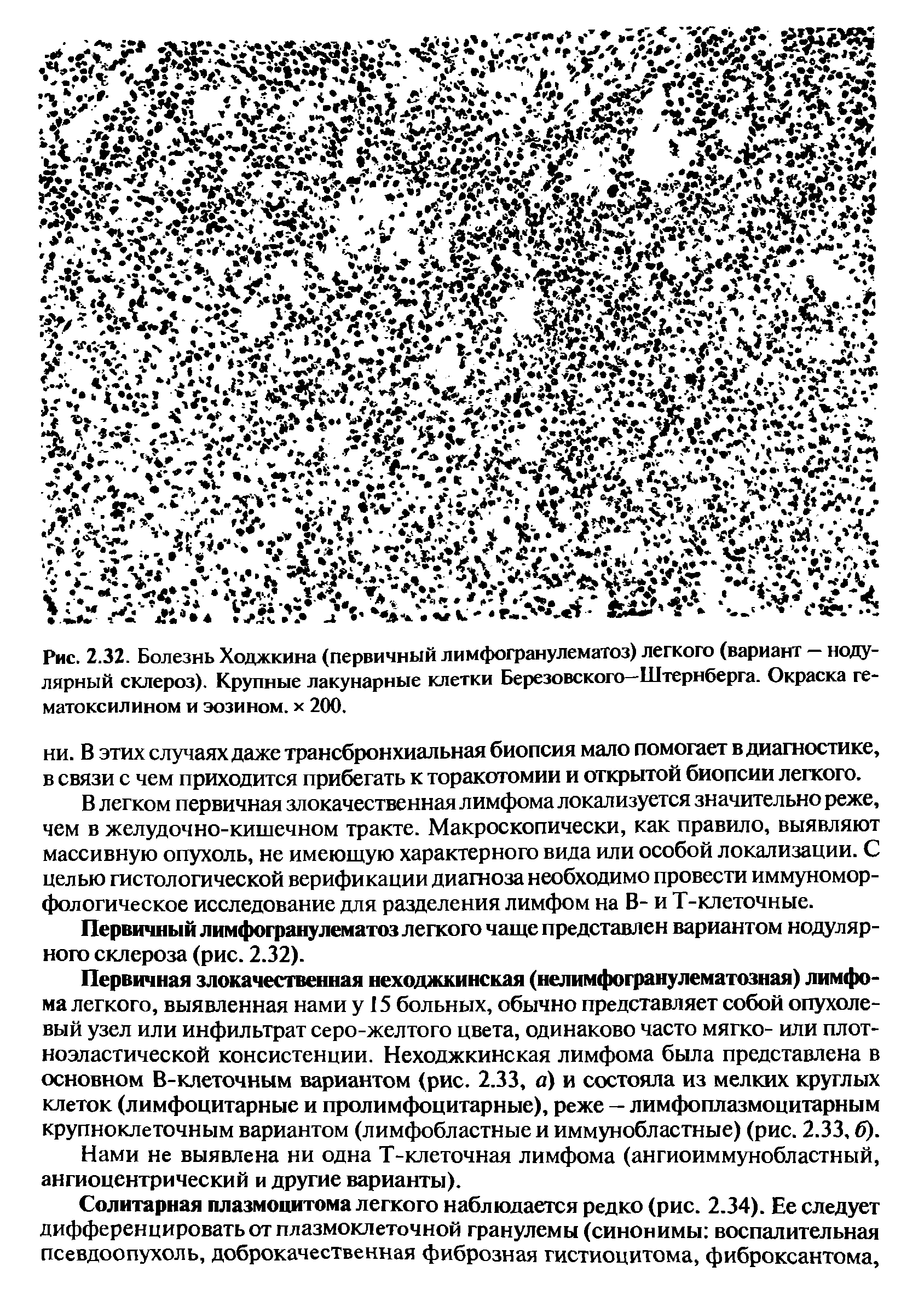 Рис. 2.32. Болезнь Ходжкина (первичный лимфогранулематоз) легкого (вариант — нодулярный склероз). Крупные лакунарные клетки Березовского—Штернберга. Окраска гематоксилином и эозином, х 200.