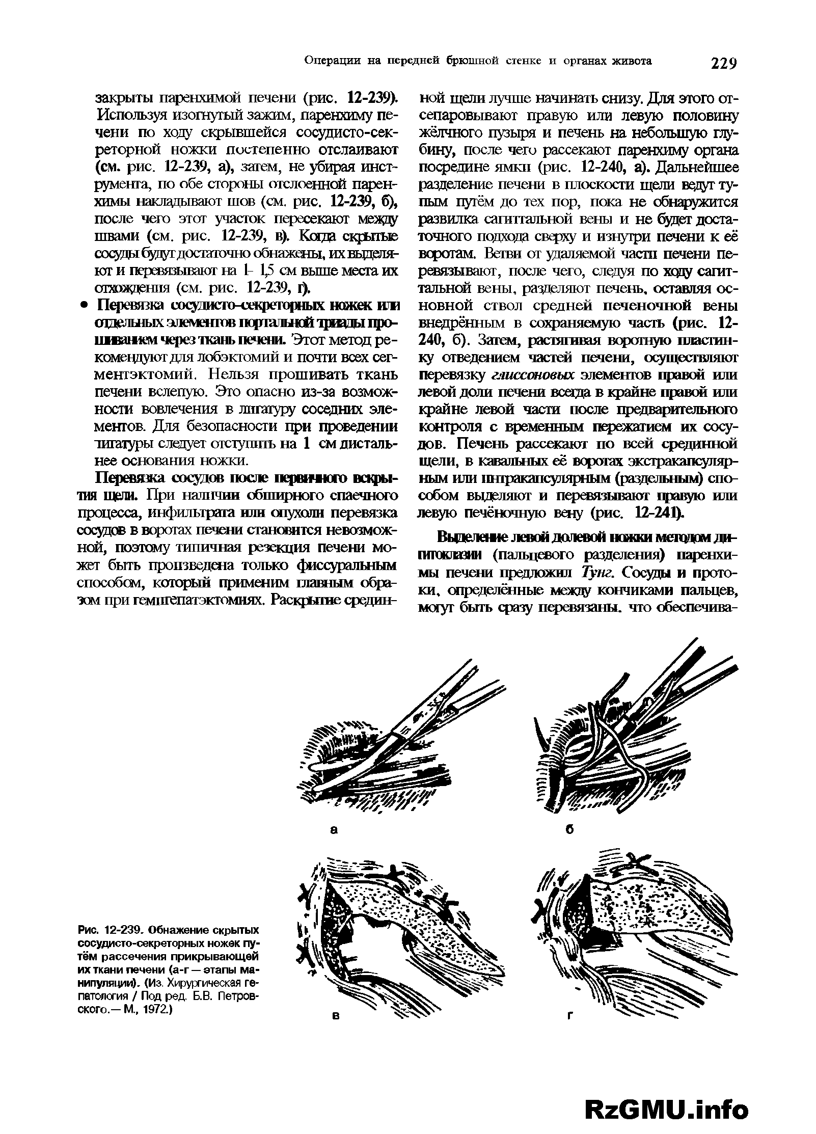 Рис. 12-239. Обнажение скрытых сосудисто-секреторных ножек путём рассечения прикрывающей их ткани печени (а-г — этапы манипуляции). (Из. Хирургическая гепатология / Под ред. Б.В. Петровского.— М., 1972.)...