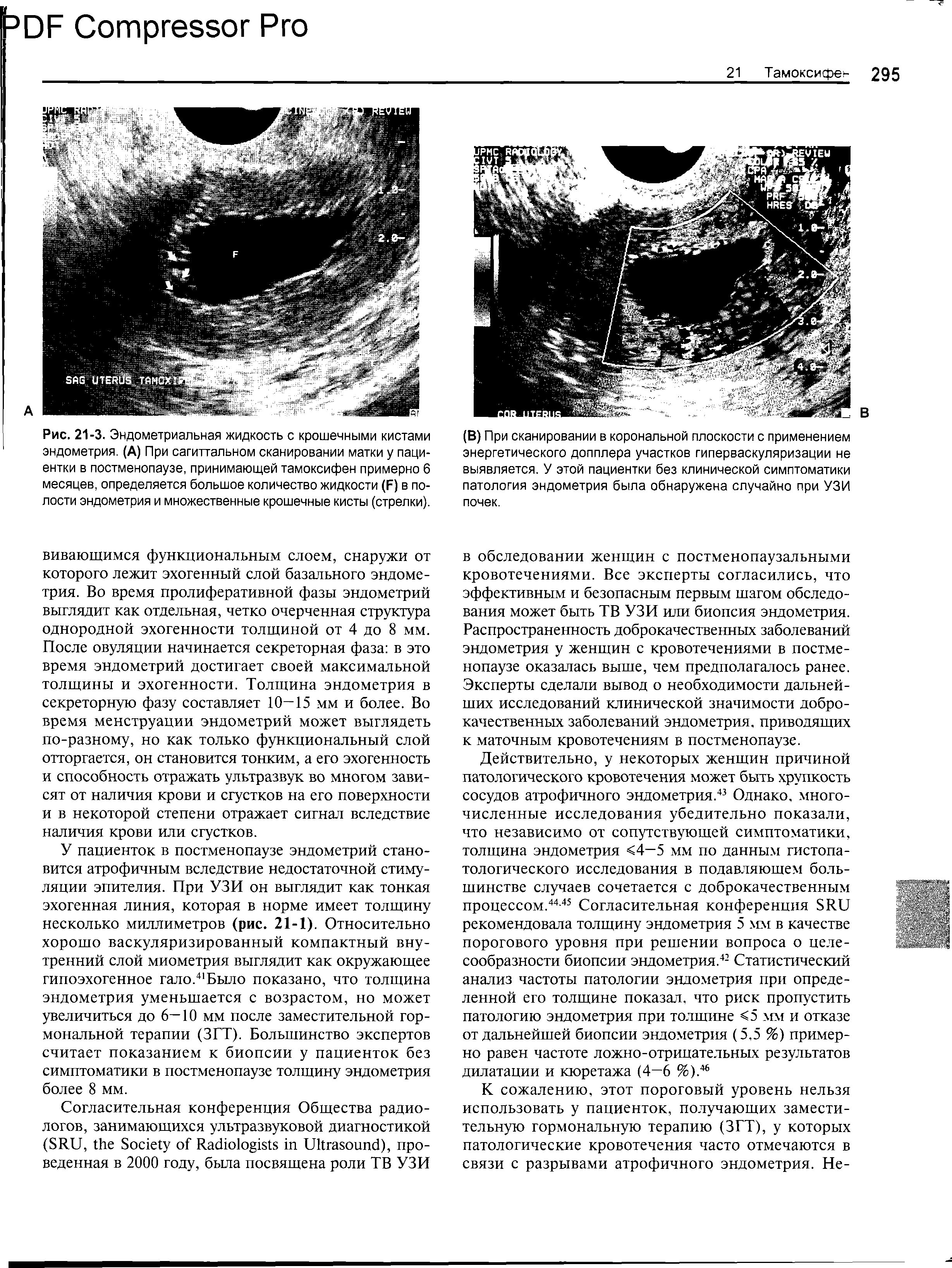 Рис. 21-3. Эндометриальная жидкость с крошечными кистами эндометрия. (А) При сагиттальном сканировании матки у пациентки в постменопаузе, принимающей тамоксифен примерно 6 месяцев, определяется большое количество жидкости ф) в полости эндометрия и множественные крошечные кисты (стрелки).