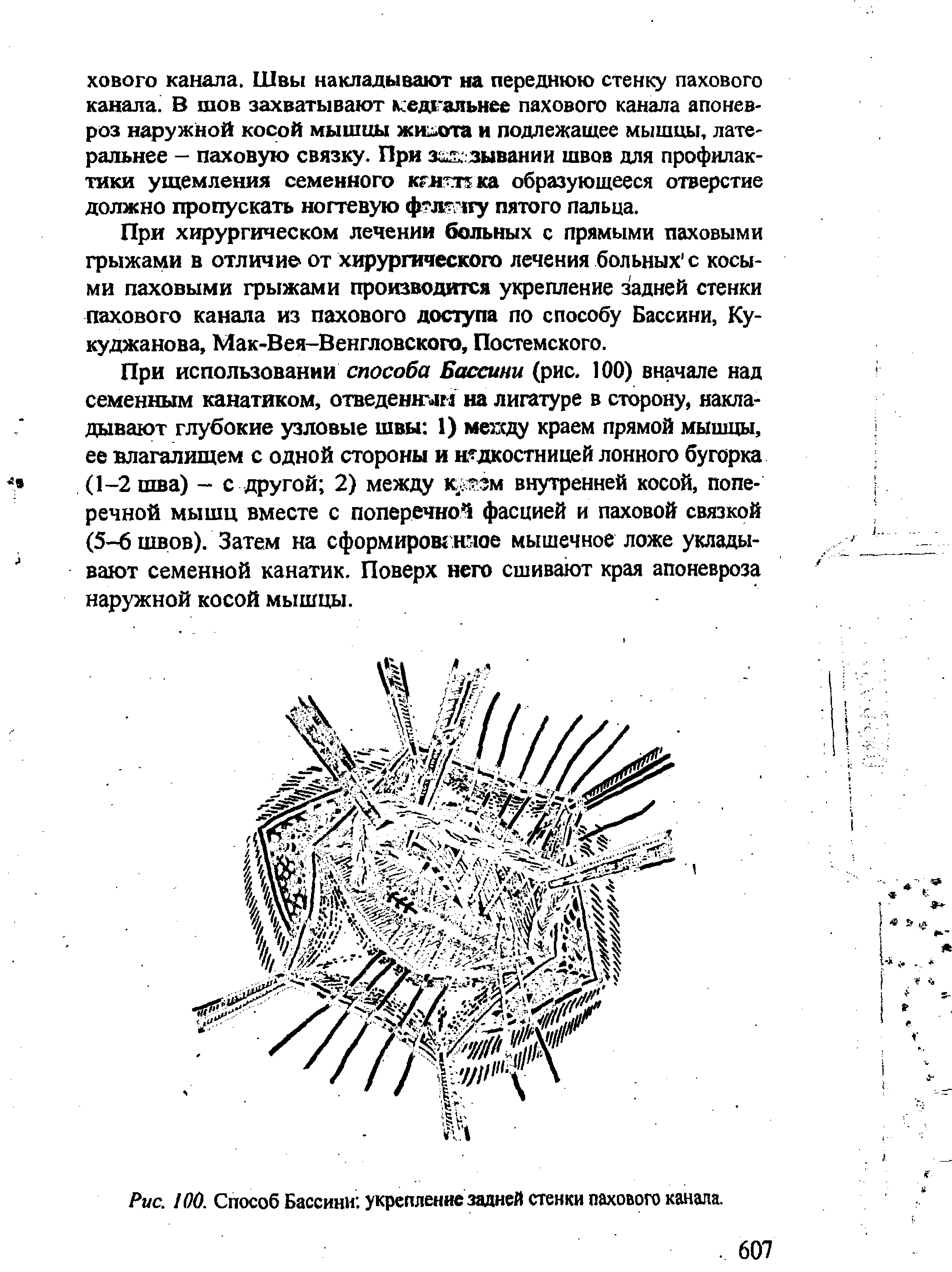 Рис. 00. Способ Бассини укрепление задней стенки пахового канала.