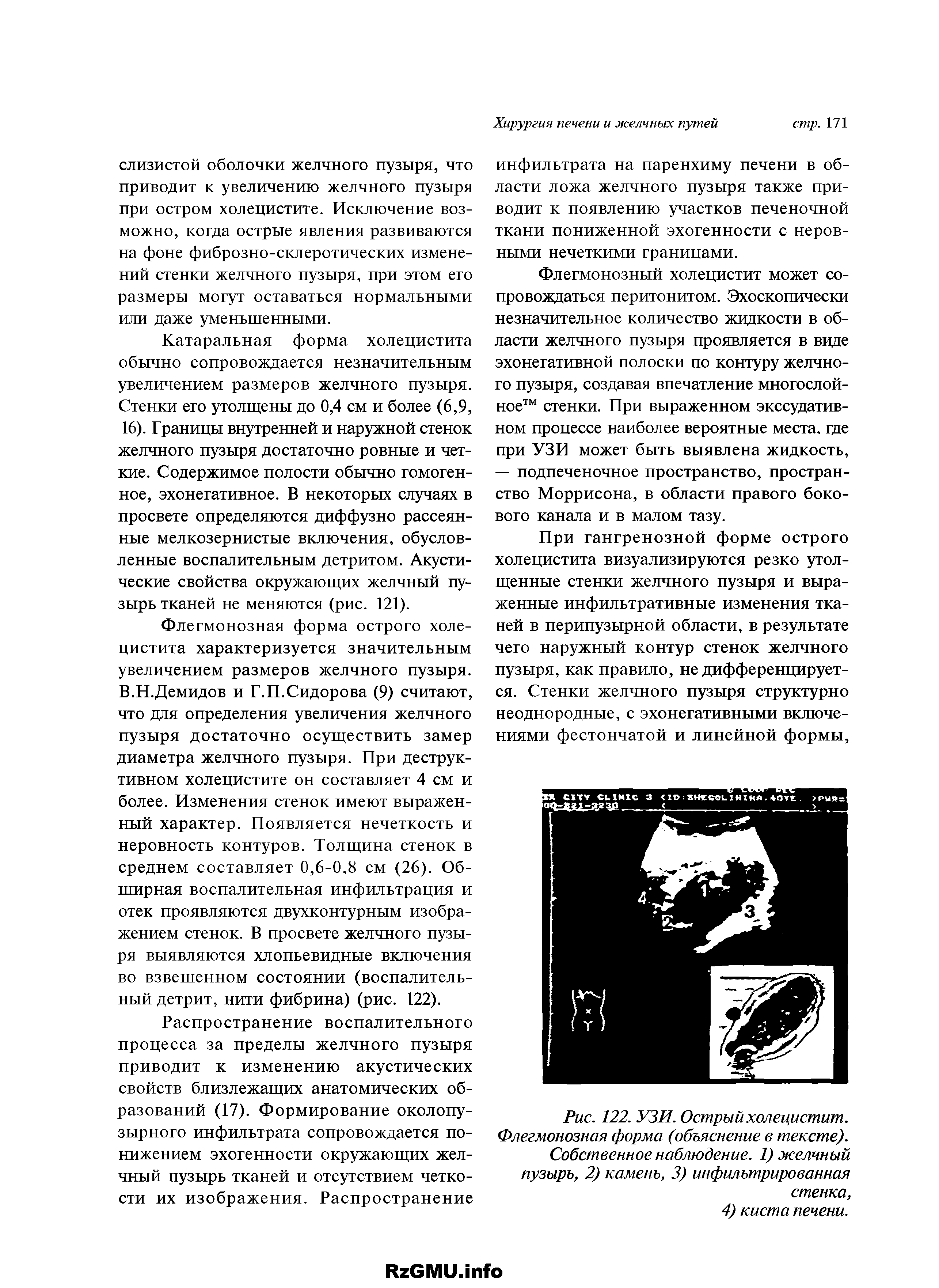 Рис. 122. УЗИ. Острый холецистит. Флегмонозная форма (объяснение в тексте).