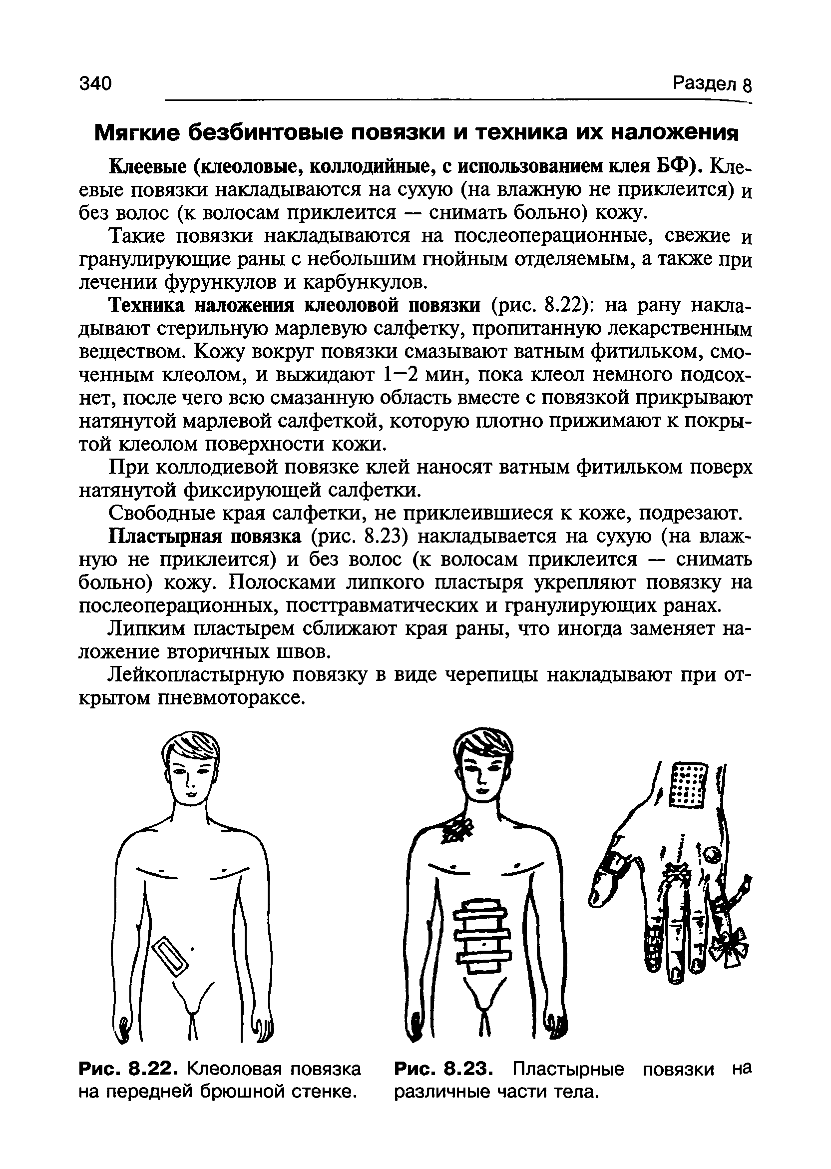 Рис. 8.22. Клеоловая повязка Рис. 8.23. Пластырные повязки на на передней брюшной стенке. различные части тела.