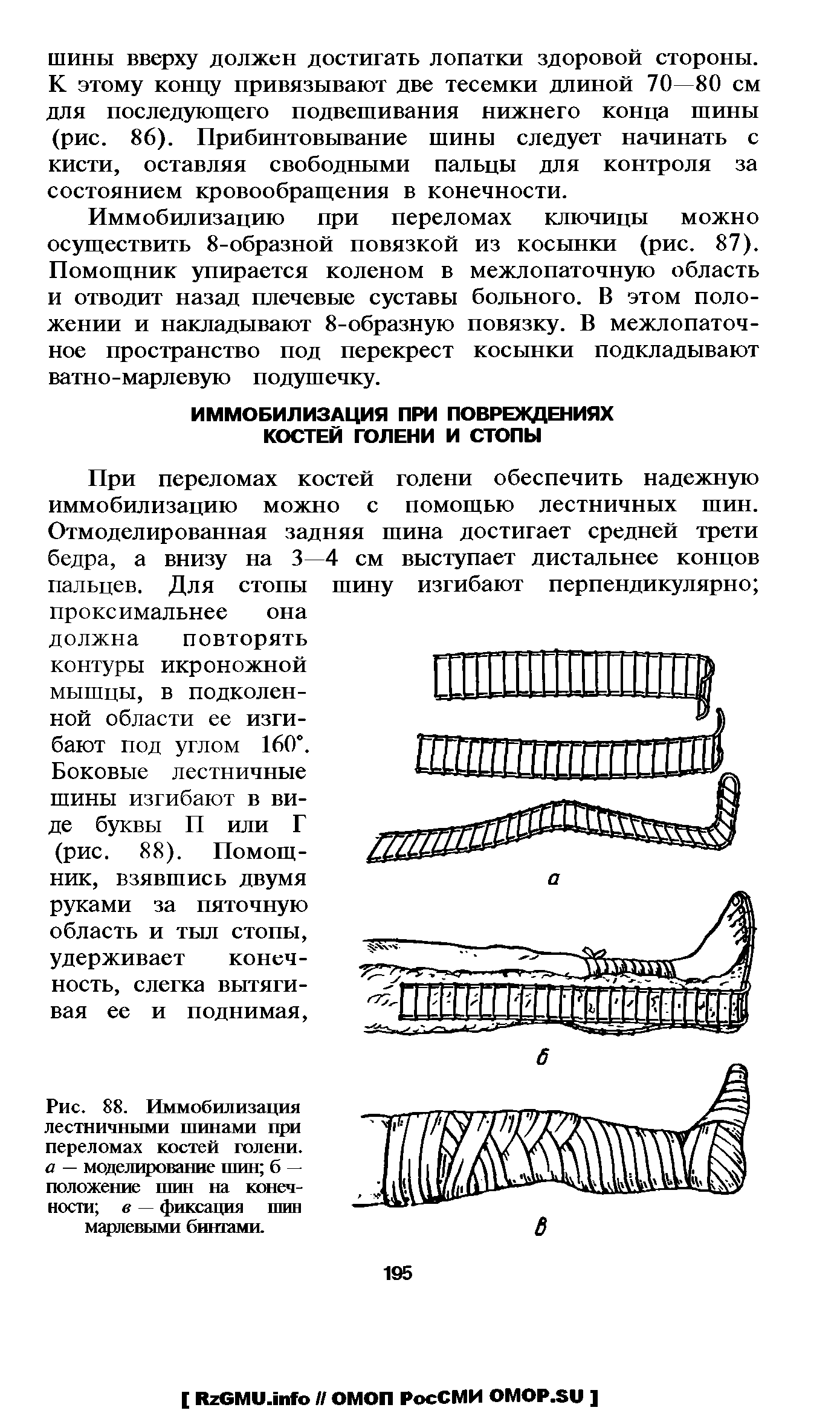 Рис. 88. Иммобилизация лестничными шинами при переломах костей голени. а — моделирование шин б — положение шин на конечности в — фиксация шин марлевыми бинтами.