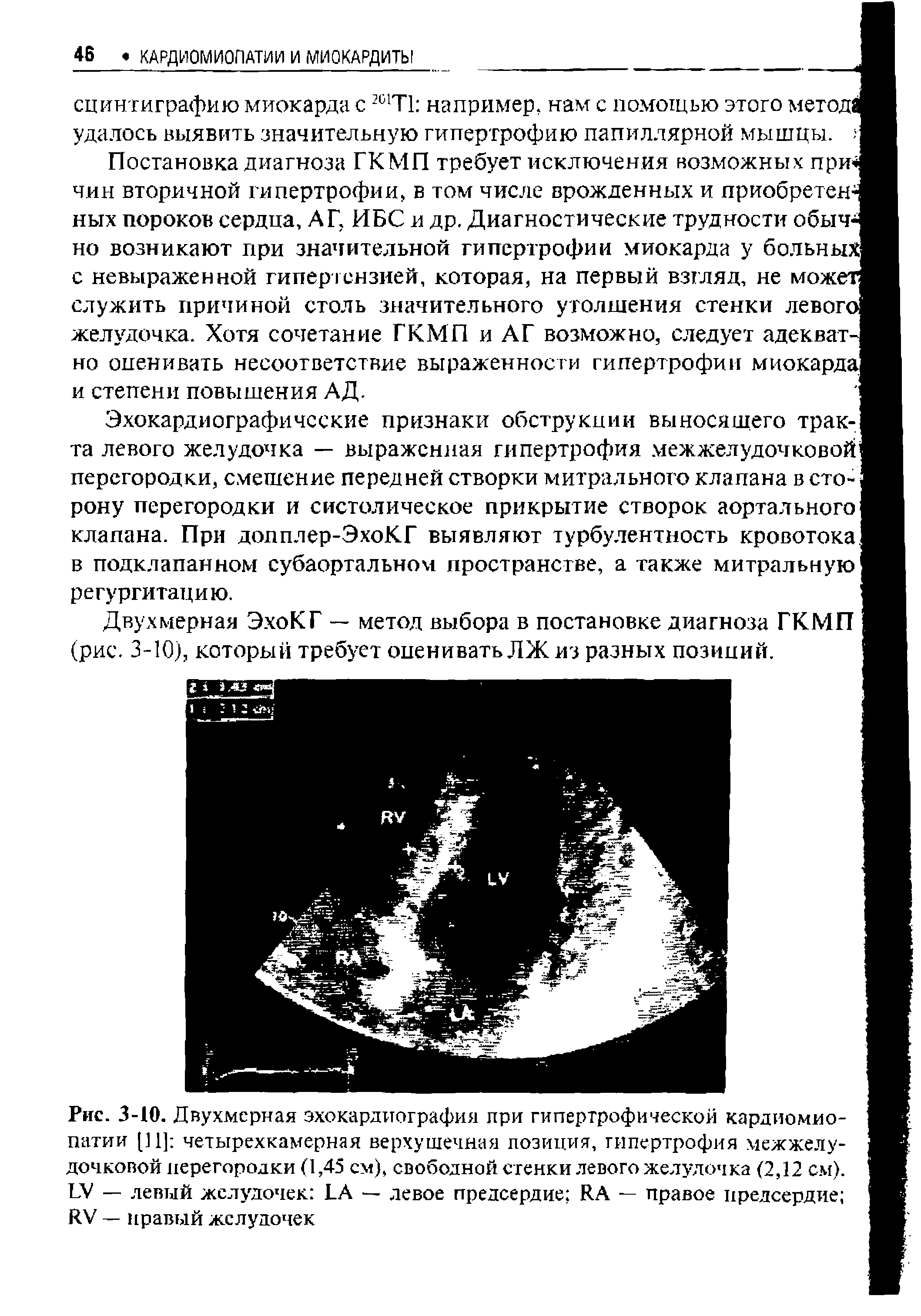 Рис. 3-10. Двухмерная эхокардиография при гипертрофической кардиомиопатии [11] четырехкамерная верхушечная позиция, гипертрофия межжелудочковой перегородки (1,45 см), свободной стенки левого желудочка (2,12 см). ЬУ — левый желудочек ЬА — левое предсердие ИА — правое предсердие ЯУ — правый желудочек...