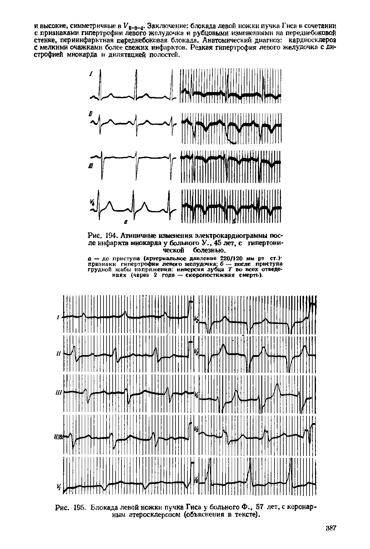 Рис. 194. Атипичные изменения электрокардиограммы после инфаркта миокарда у больного У., 45 лет, с гипертонической болезнью.