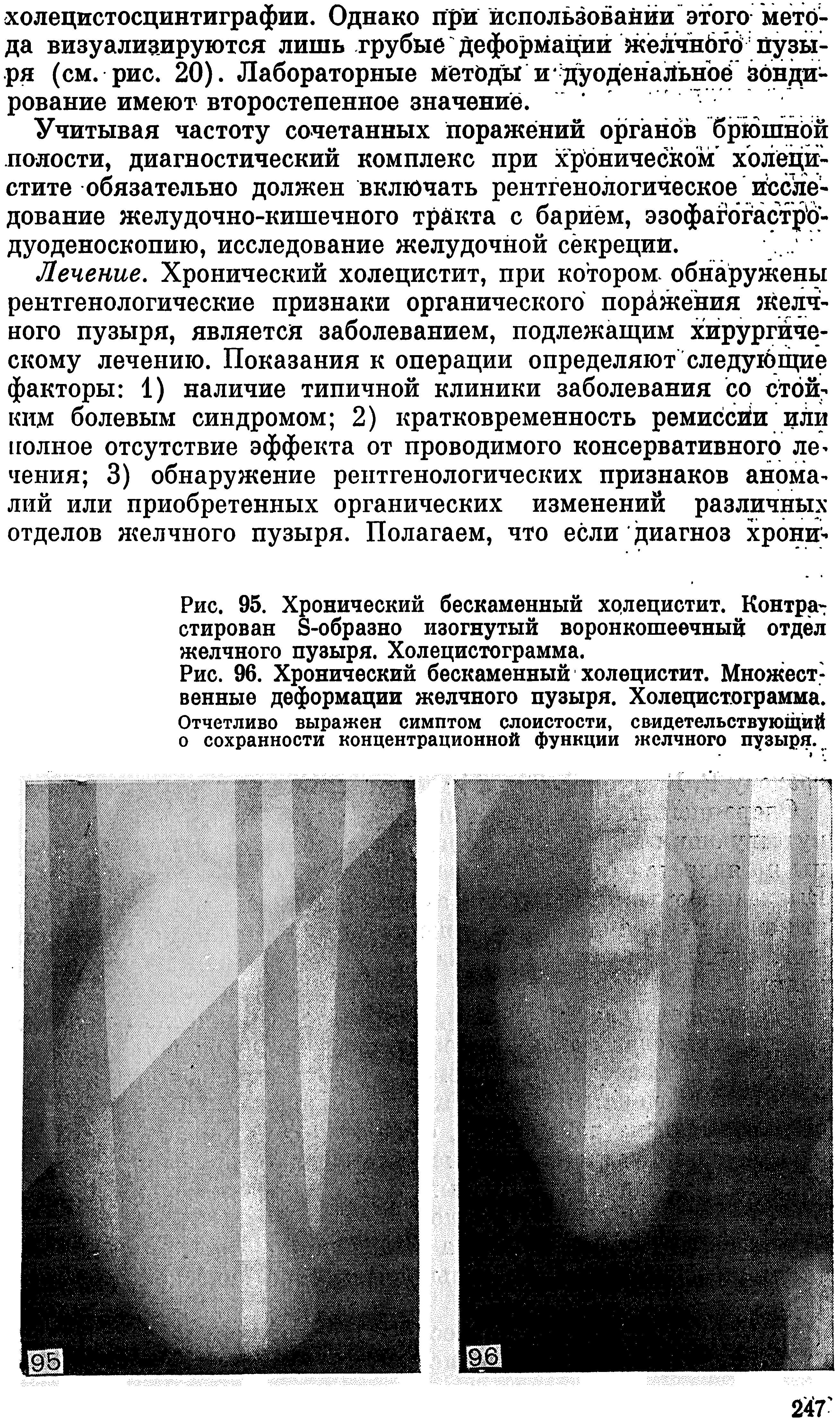 Рис. 96. Хронический бескаменный холецистит. Множественные деформации желчного пузыря. Холецистограмма. Отчетливо выражен симптом слоистости, свидетельствующий о сохранности концентрационной функции желчного пузыря.