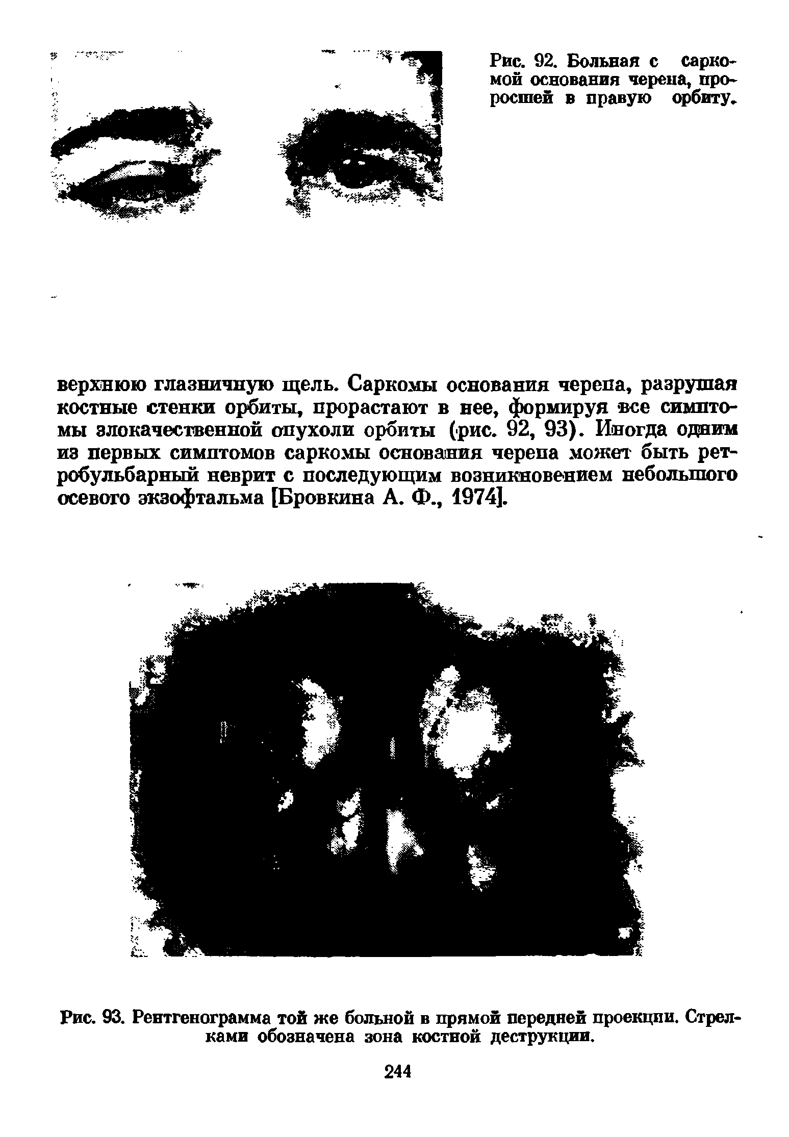 Рис. 93. Рентгенограмма той же больной в прямой передней проекции. Стрелками обозначена зона костной деструкции.