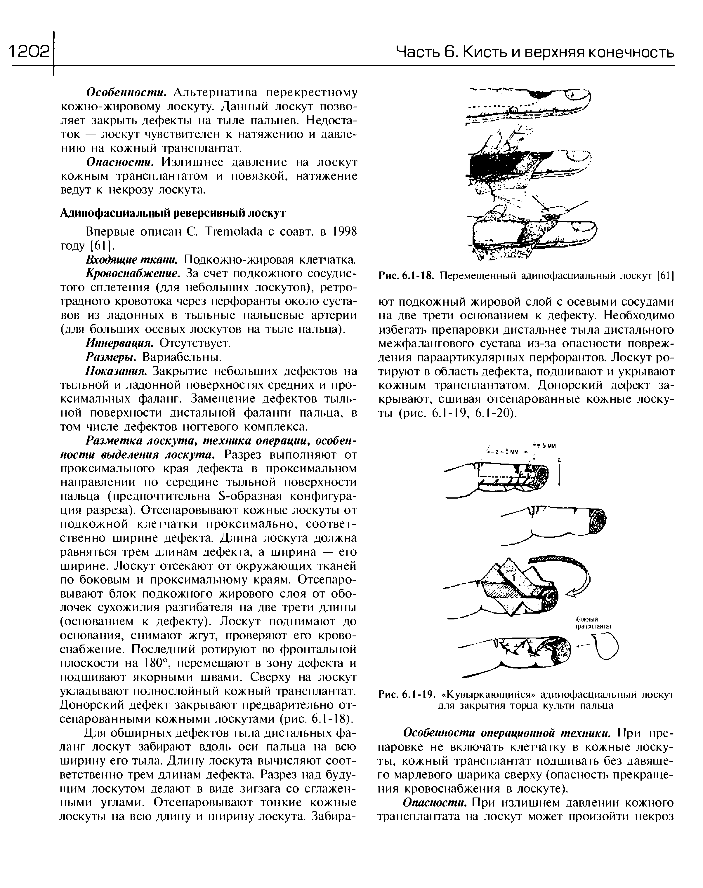 Рис. 6.1-19. Кувыркающийся адипофасциальный лоскут для закрытия торца культи пальца...