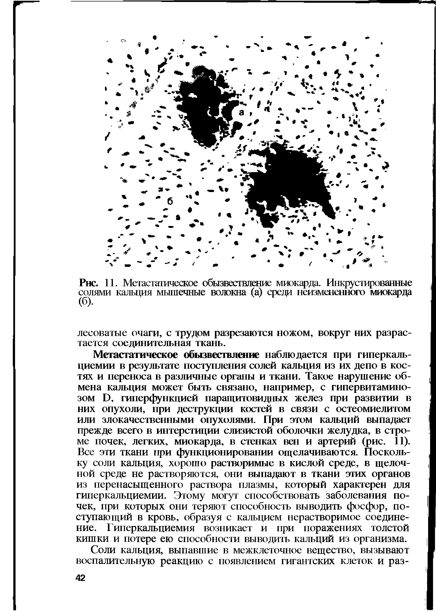 Рис. 11. Метастатическое обызвествление миокарда. Инкрустированные солями кальция мышечные волокна (а) среди неизмененного миокарда (б).