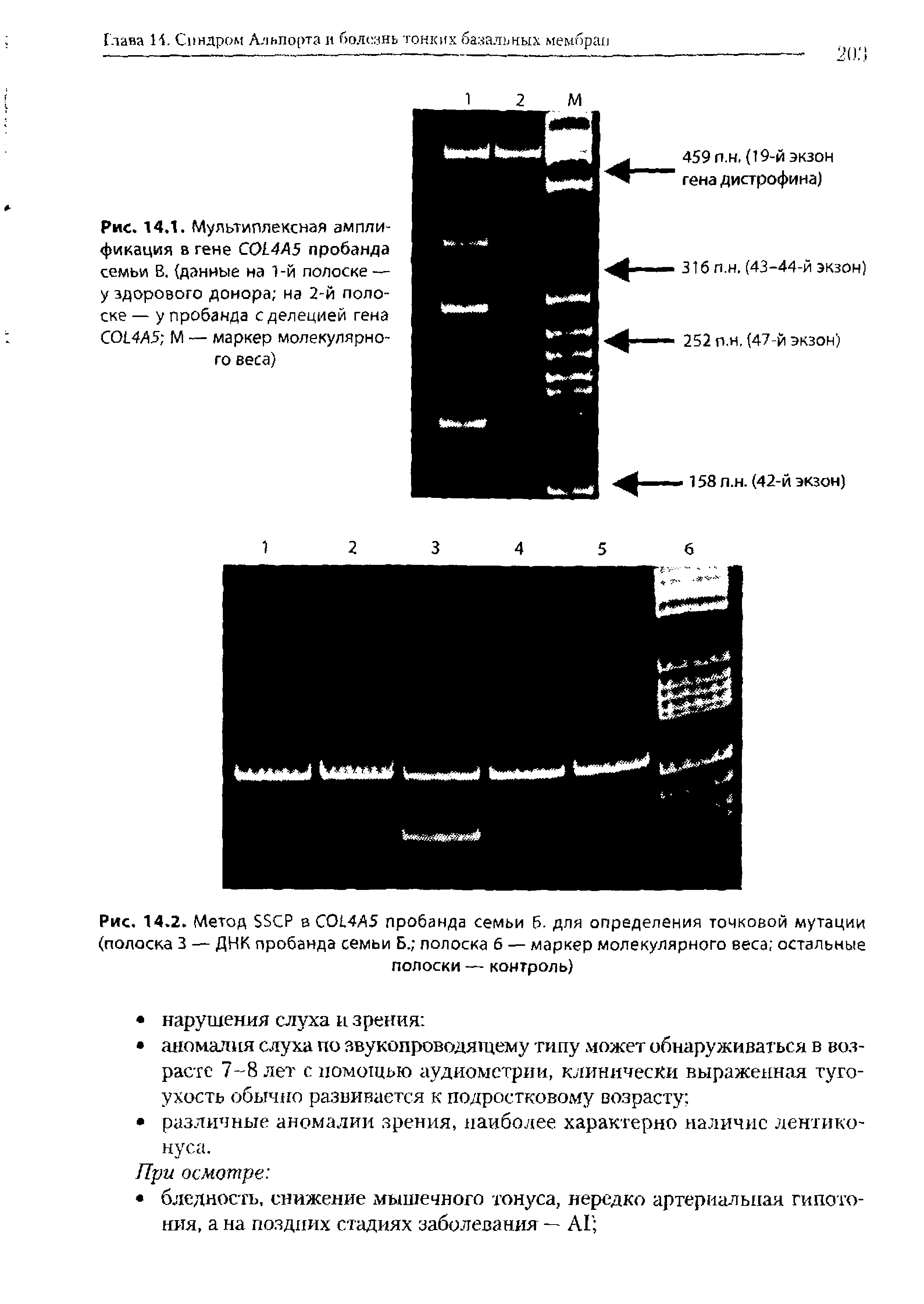 Рис. 14.2. Метод 55СР в СО14А5 пробанда семьи б. для определения точковой мутации (полоска 3 — ДНК пробанда семьи Б. полоска б — маркер молекулярного веса остальные полоски — контроль)...