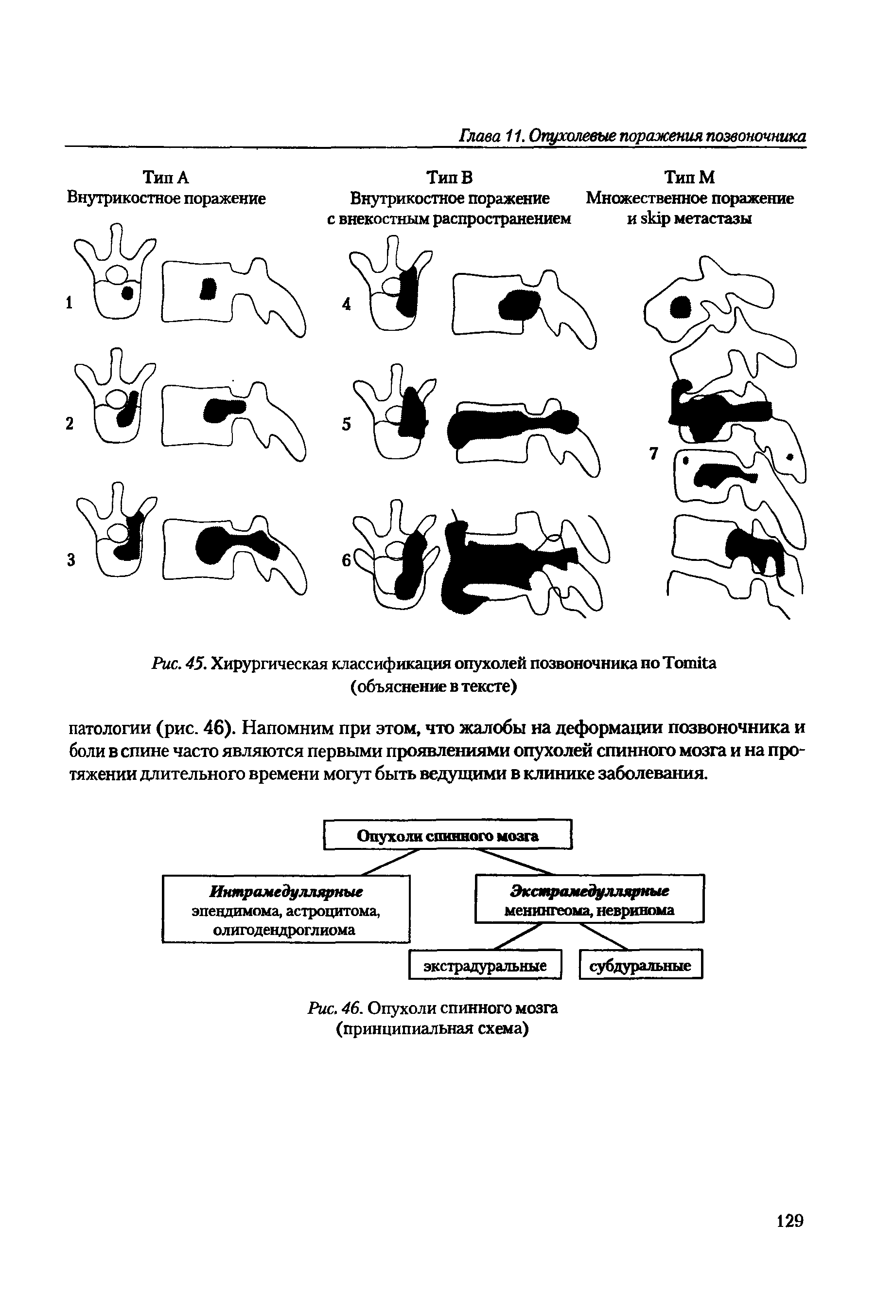 Рис. 45. Хирургическая классификация опухолей позвоночника по T (объяснение в тексте)...