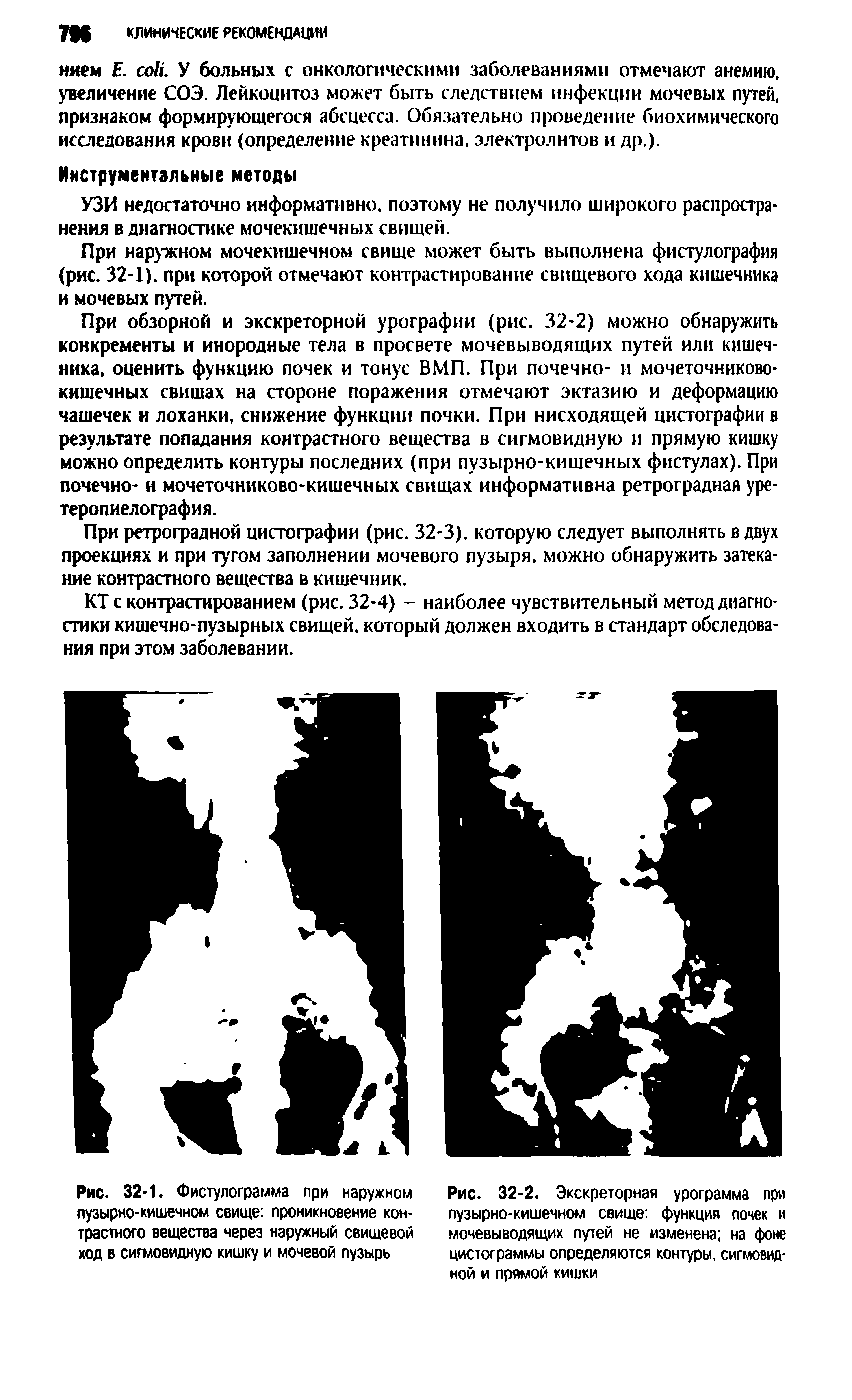 Рис. 32-1. Фистулограмма при наружном пузырно-кишечном свище проникновение контрастного вещества через наружный свищевой ход в сигмовидную кишку и мочевой пузырь...