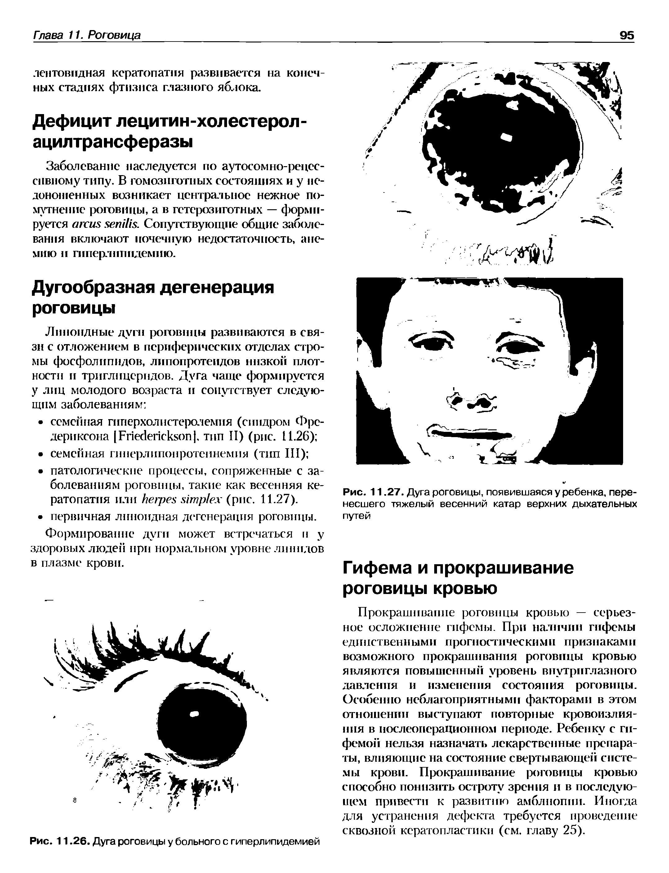 Рис. 11.27. Дуга роговицы, появившаяся у ребенка, перенесшего тяжелый весенний катар верхних дыхательных путей...