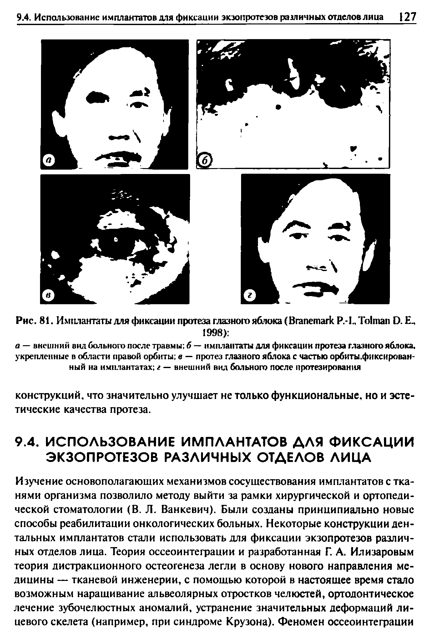 Рис. 81. Имплантаты для фиксации протеза глазного яблока (B P.-L T D. Е.. 1998) ...