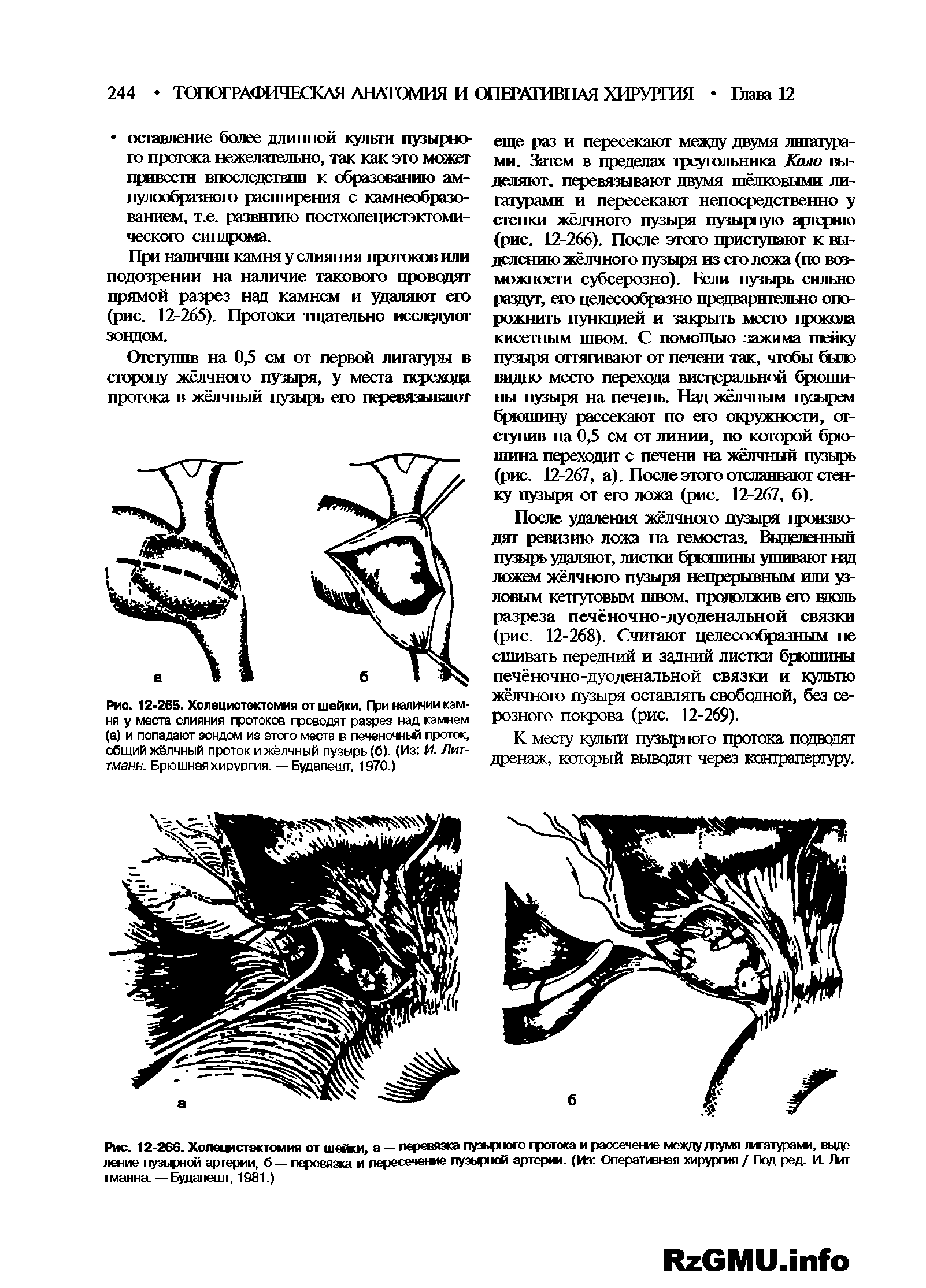 Рис. 12-265. Холецистэктомия от шейки. При наличии камня у места слияния протоков проводят разрез над камнем (а) и попадают зондом из того места в печеночный проток, общий жёлчный проток и жёлчный пузырь (б). (Из И. Лит-тманн. Брюшная хирургия. — Будапешт. 1970.)...