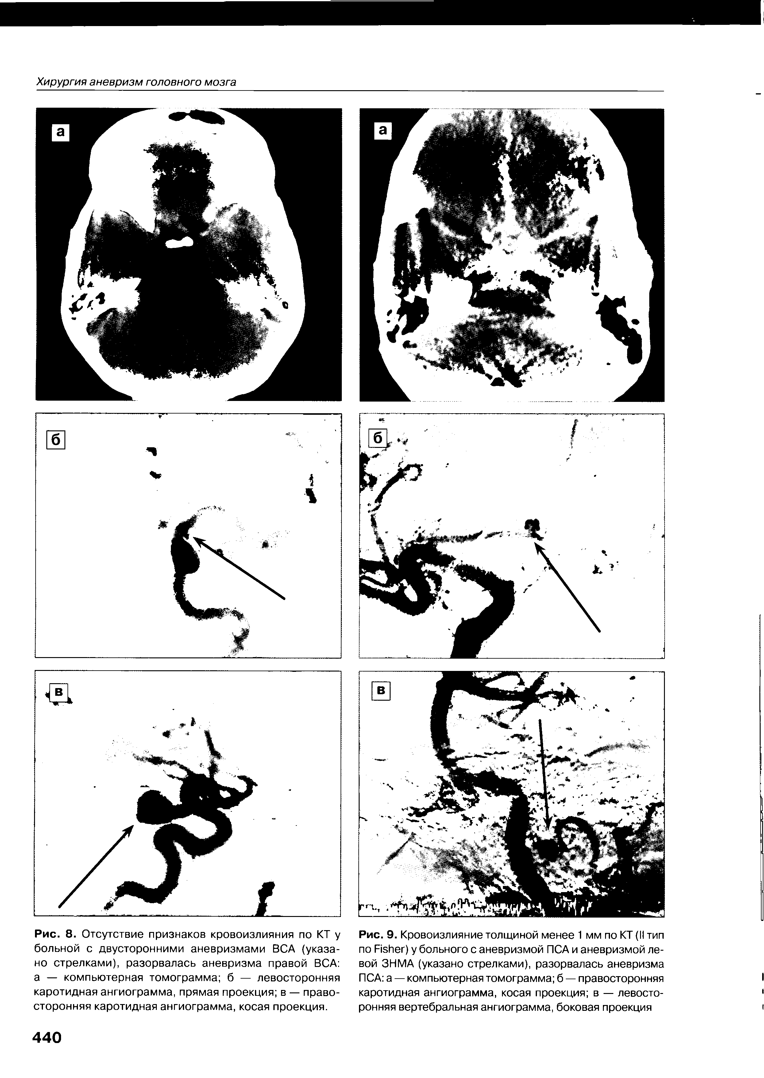 Рис. 8. Отсутствие признаков кровоизлияния по КТ у больной с двусторонними аневризмами ВСА (указано стрелками), разорвалась аневризма правой ВСА а — компьютерная томограмма б — левосторонняя каротидная ангиограмма, прямая проекция в — правосторонняя каротидная ангиограмма, косая проекция.