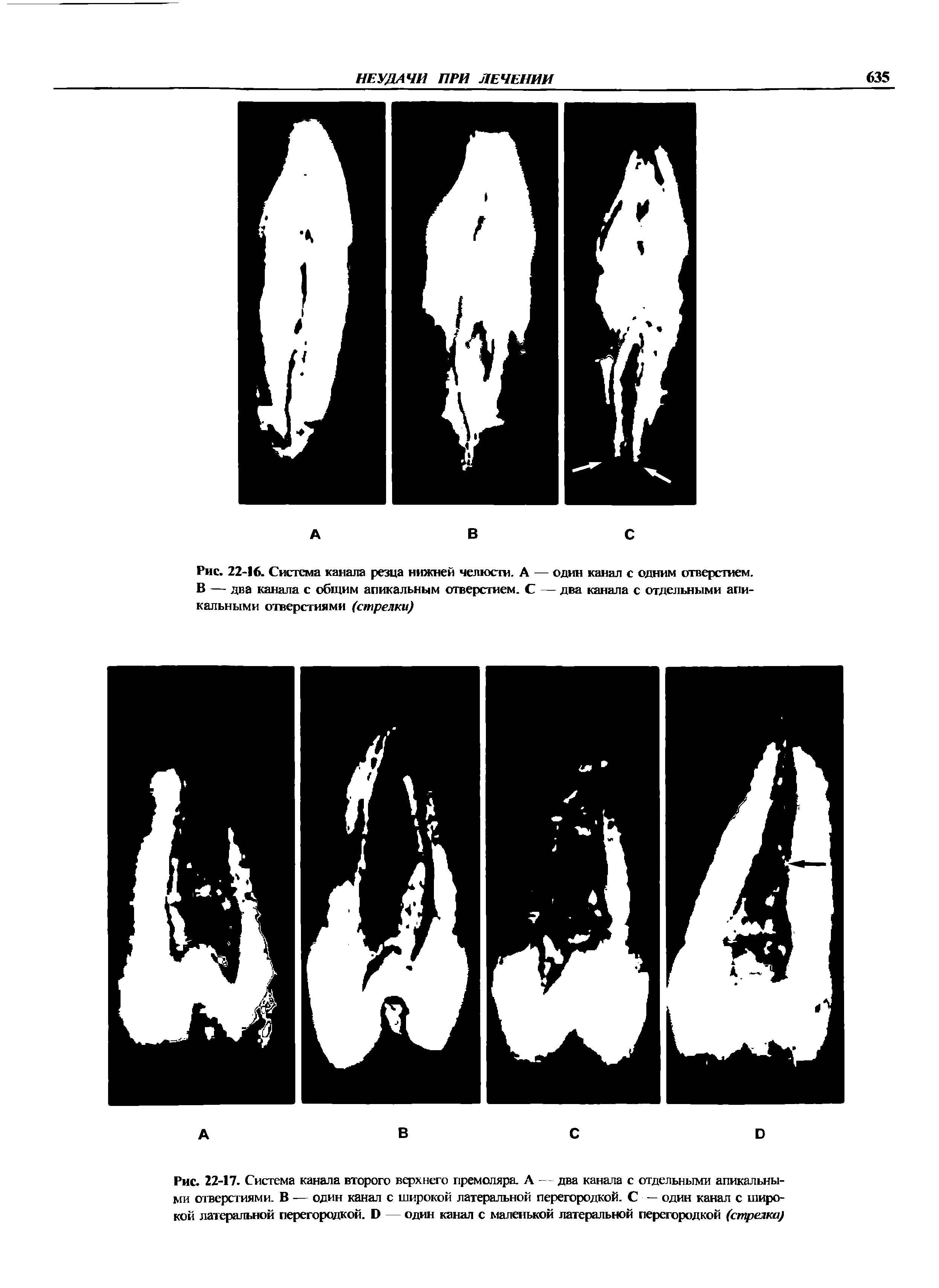 Рис. 22-17. Система канала второго верхнего премоляра. А — два канала с отдельными апикальными отверстиями. В — один канал с широкой латеральной перегородкой. С — один канал с широкой латеральной перегородкой. Э — один канал с маленькой латеральной перегородкой (стрелка)...