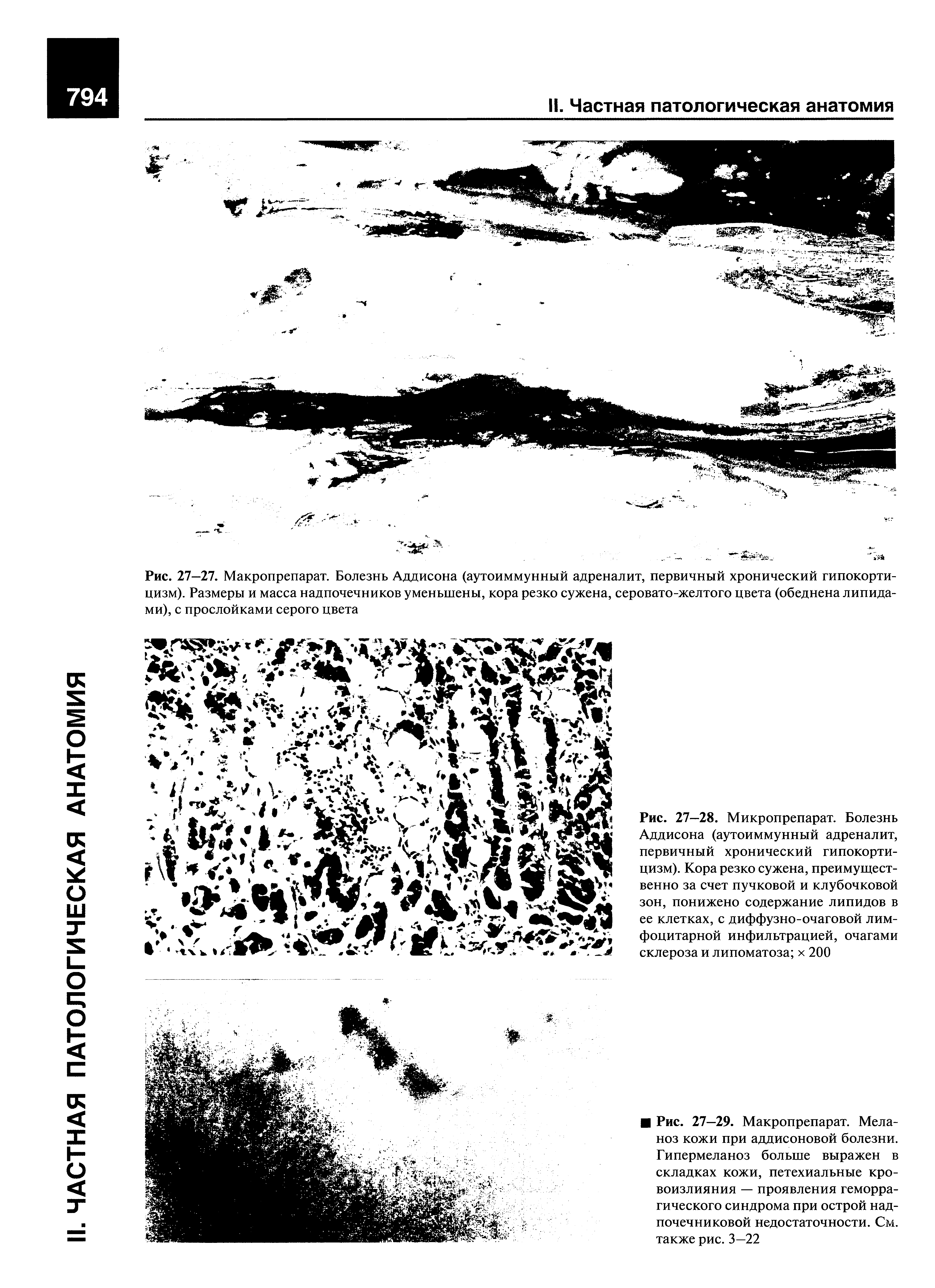 Рис. 27—28. Микропрепарат. Болезнь Аддисона (аутоиммунный адреналит, первичный хронический гипокорти-цизм). Кора резко сужена, преимущественно за счет пучковой и клубочковой зон, понижено содержание липидов в ее клетках, с диффузно-очаговой лимфоцитарной инфильтрацией, очагами склероза и липоматоза х 200...