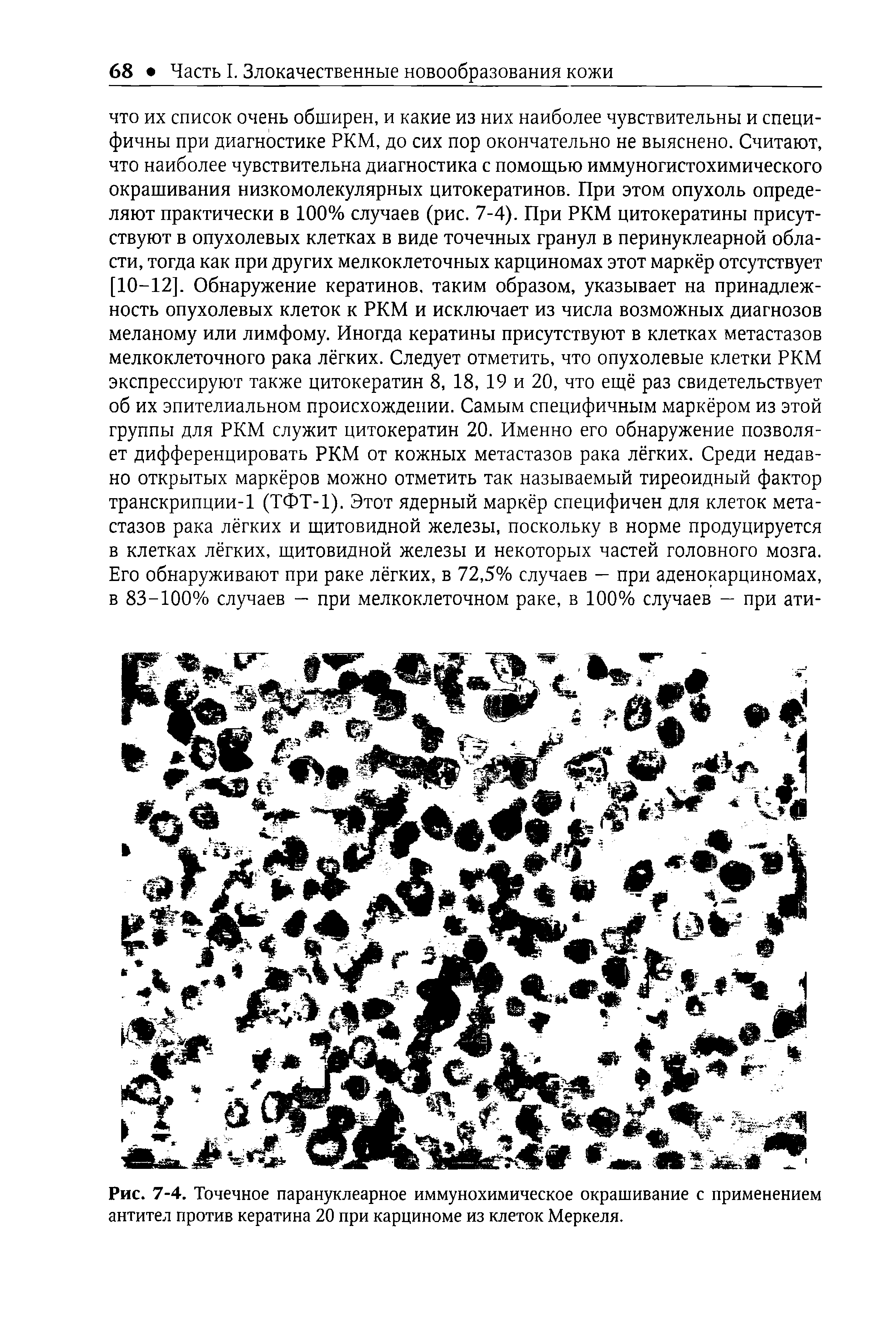 Рис. 7-4. Точечное парануклеарное иммунохимическое окрашивание с применением антител против кератина 20 при карциноме из клеток Меркеля.