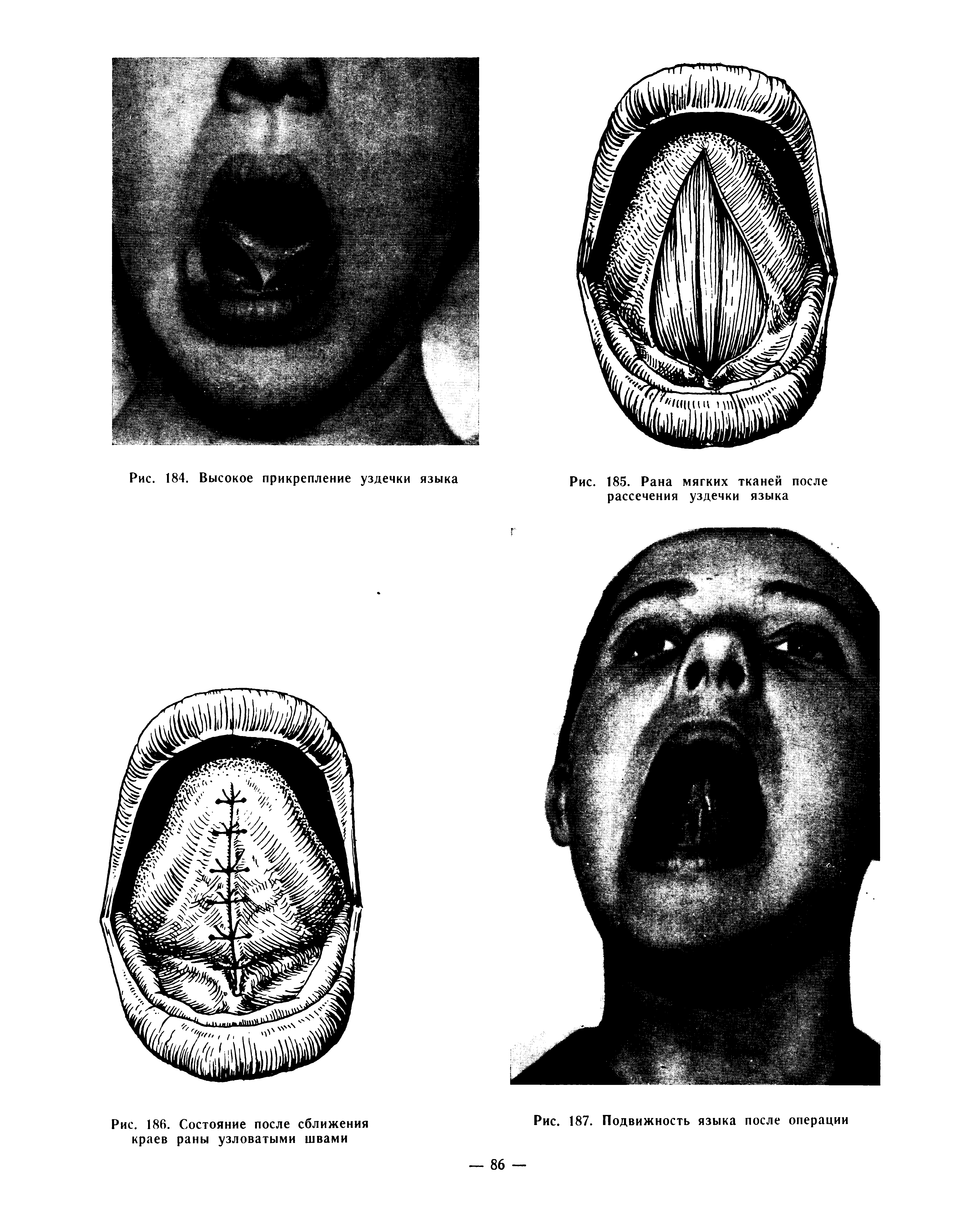 Рис. 185. Рана мягких тканей после рассечения уздечки языка...