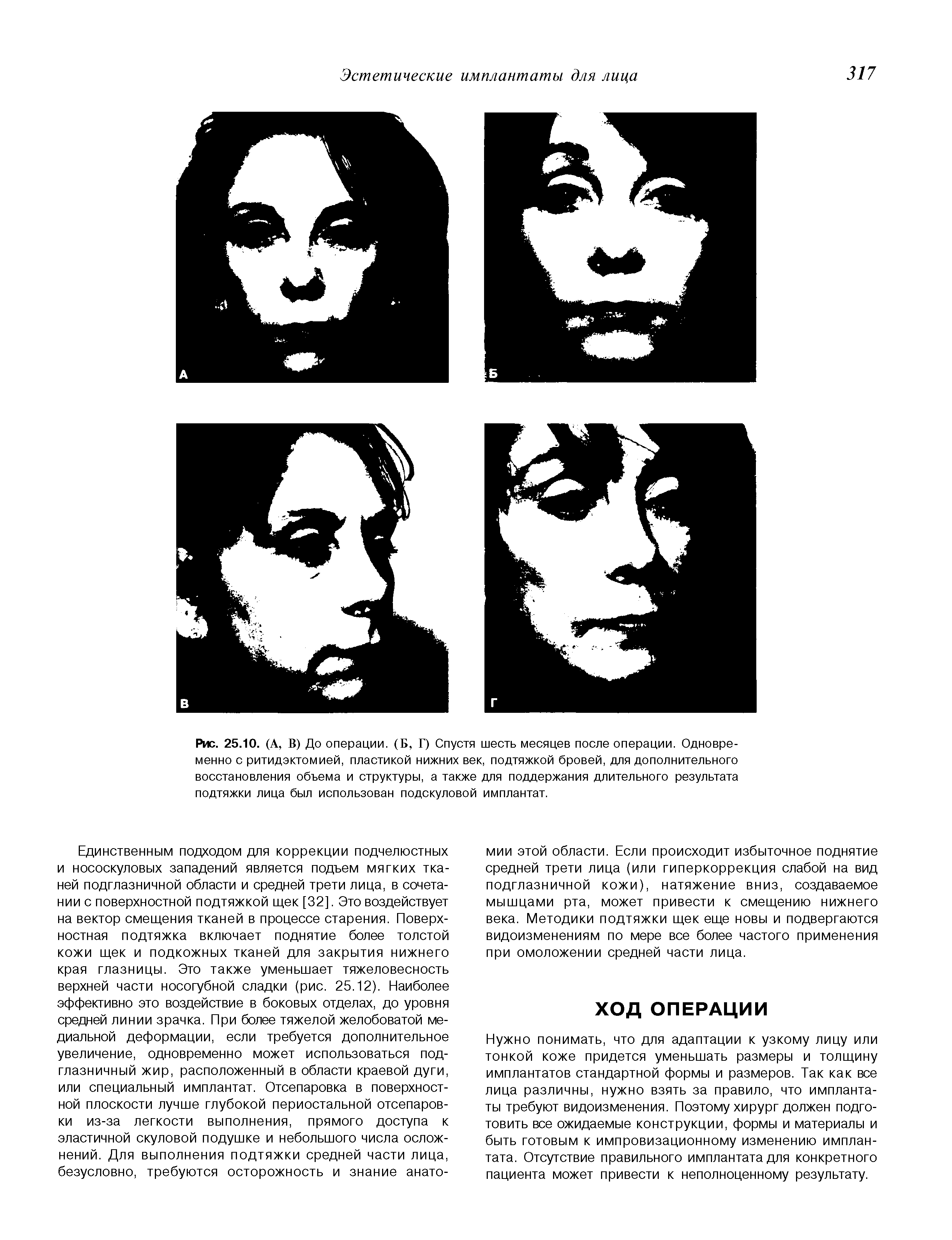 Рис. 25.10. (А, В) До операции. (Б, Г) Спустя шесть месяцев после операции. Одновременно с ритидэктомией, пластикой нижних век, подтяжкой бровей, для дополнительного восстановления объема и структуры, а также для поддержания длительного результата подтяжки лица был использован подскуловой имплантат.