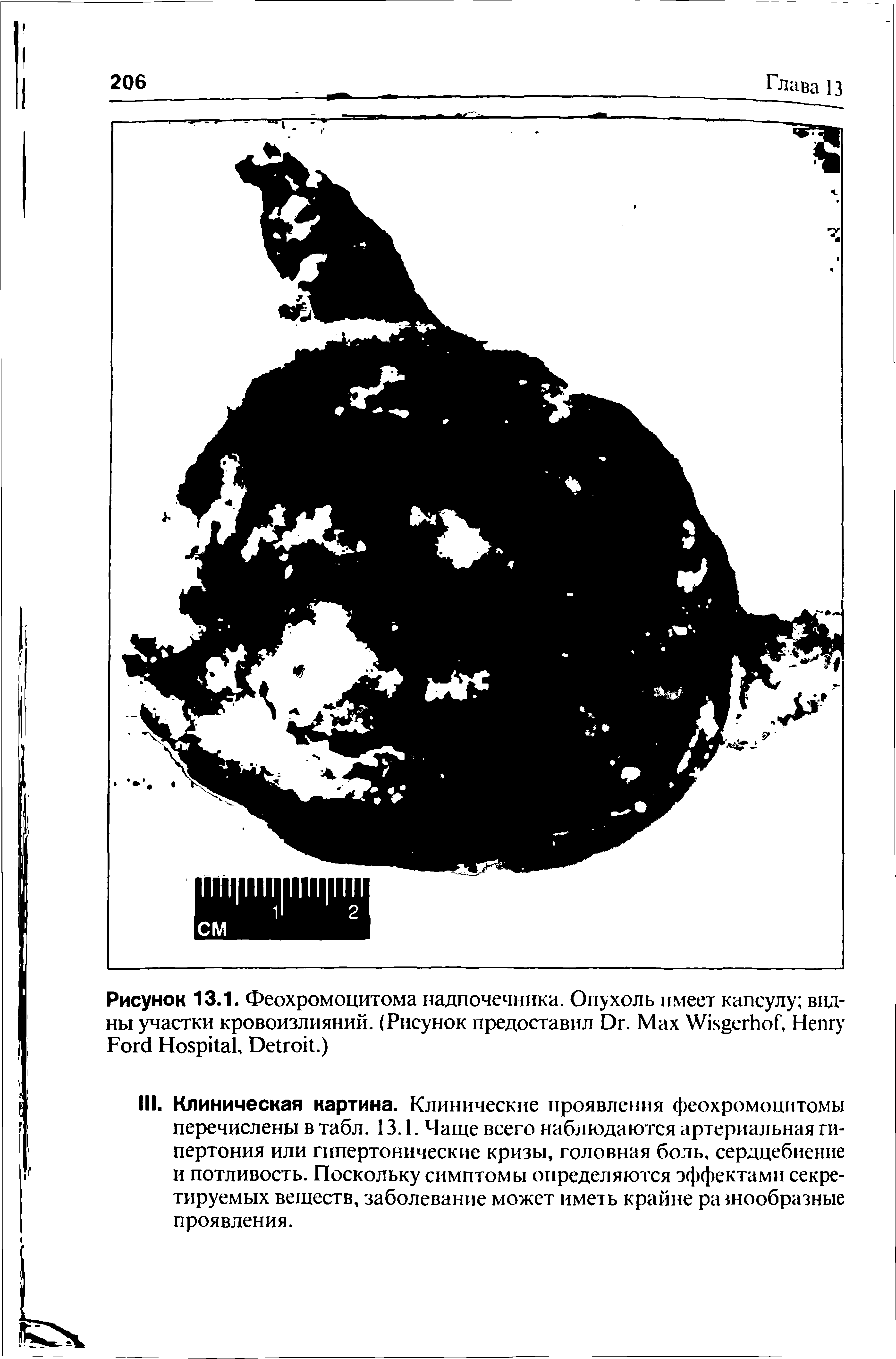 Рисунок 13.1. Феохромоцитома надпочечника. Опухоль имеет капсулу видны участки кровоизлияний. (Рисунок предоставил D . Мах W , H F H , D .)...