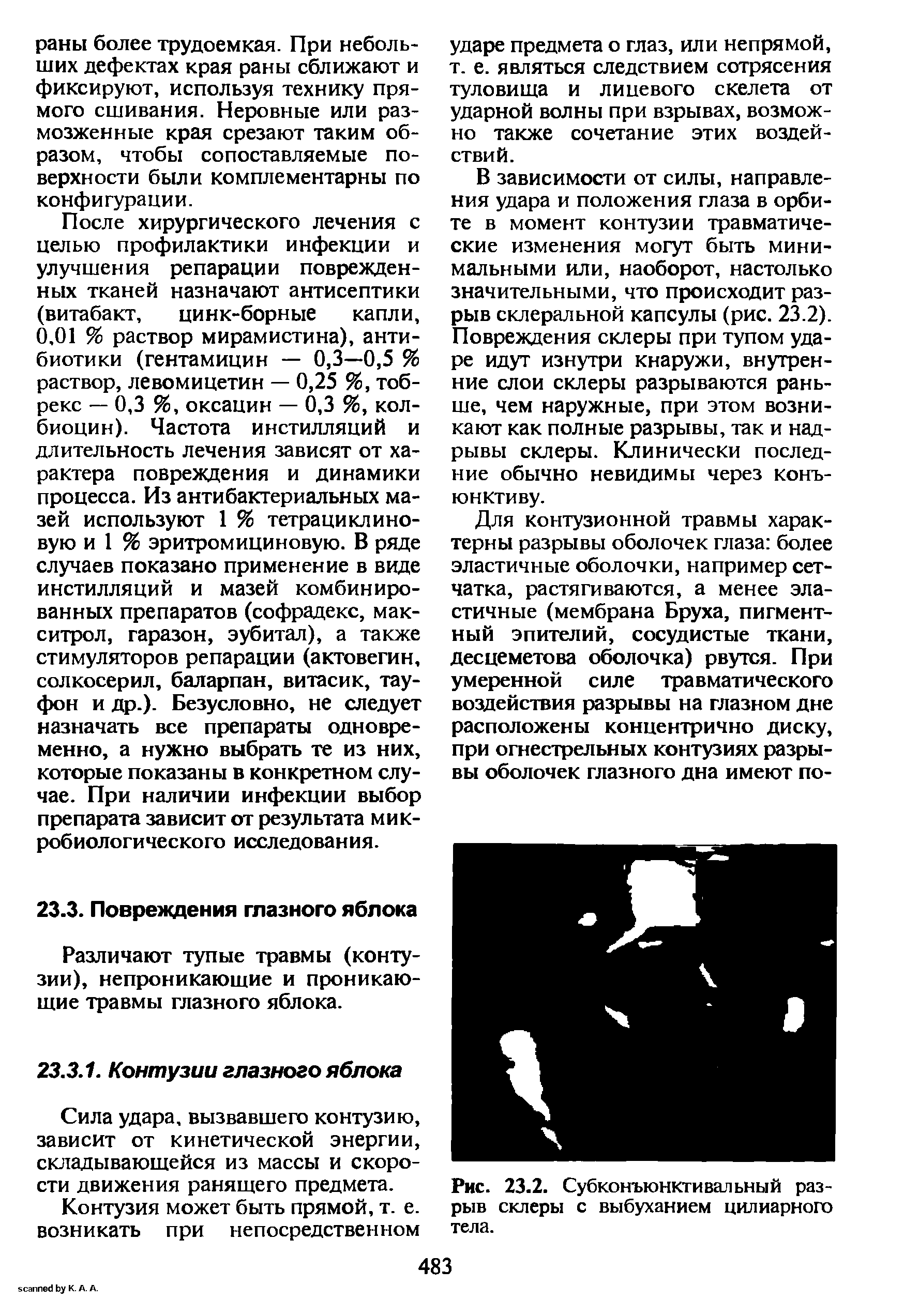 Рис. 23.2. Субконъюнктивальный разрыв склеры с выбуханием цилиарного тела.