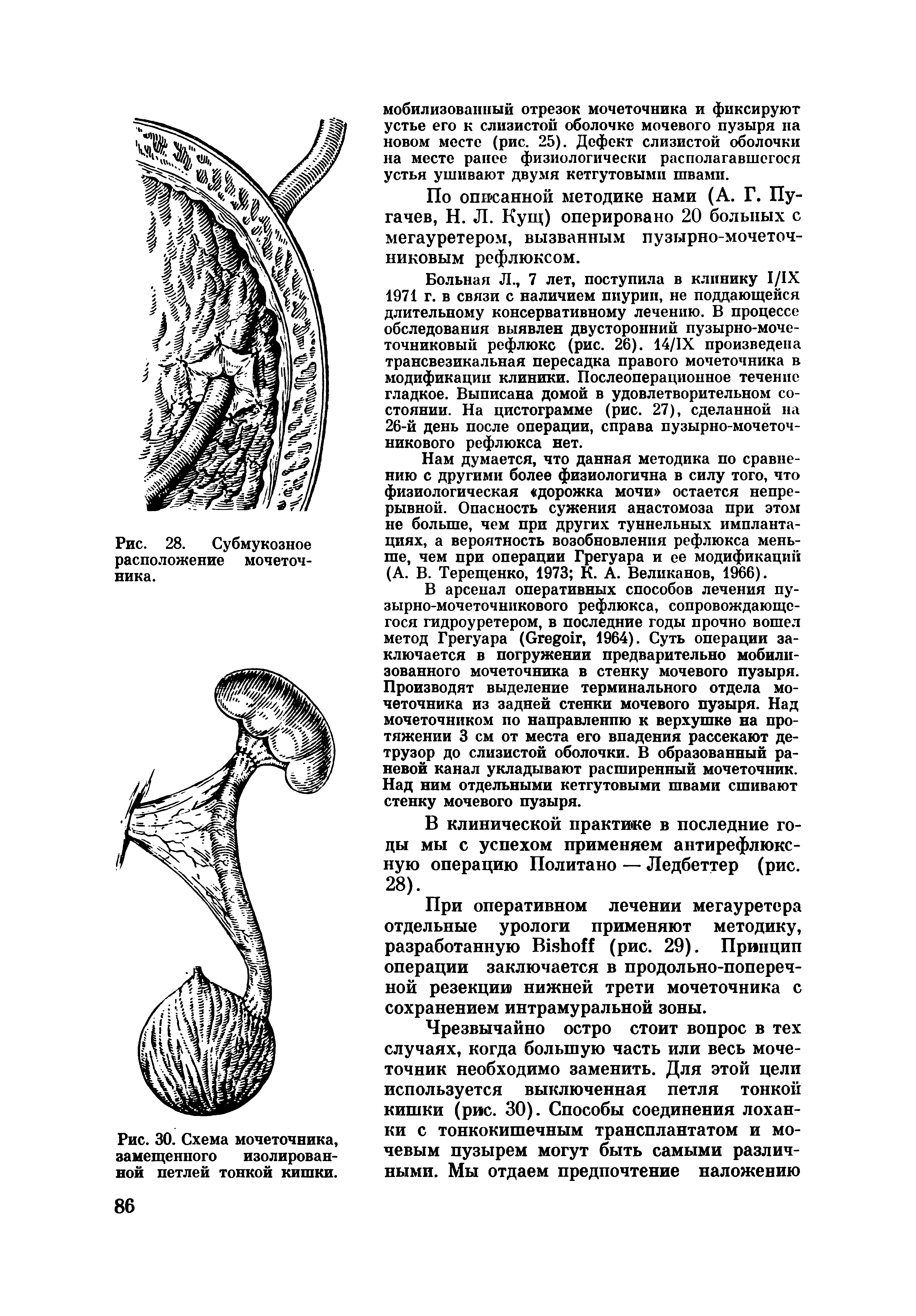 Рис. 30. Схема мочеточника, замещенного изолированной петлей тонкой кишки.