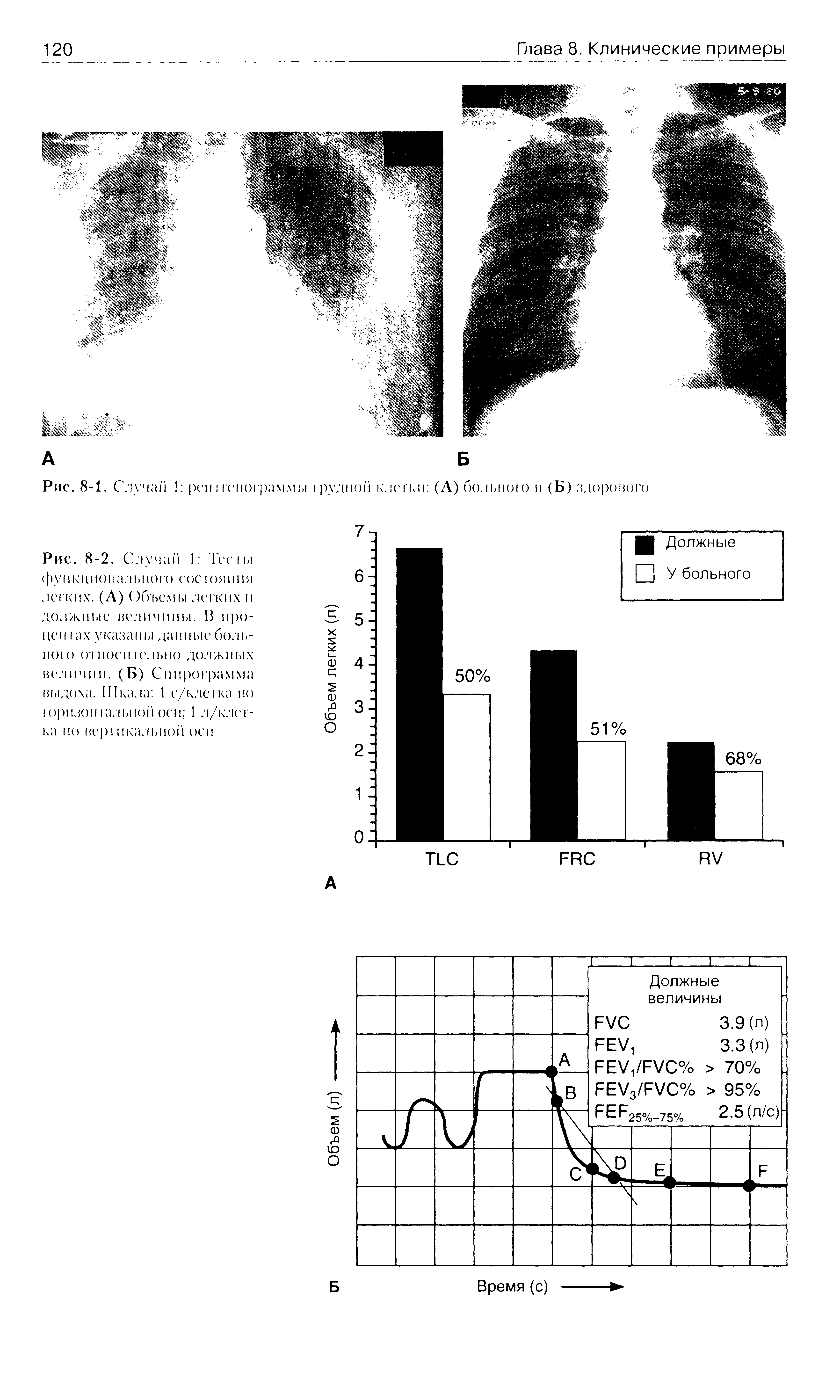 Рис. 8-1. С лучай 1 реи сонограммы рудной клегкн (А) больною и (Б) здорового...