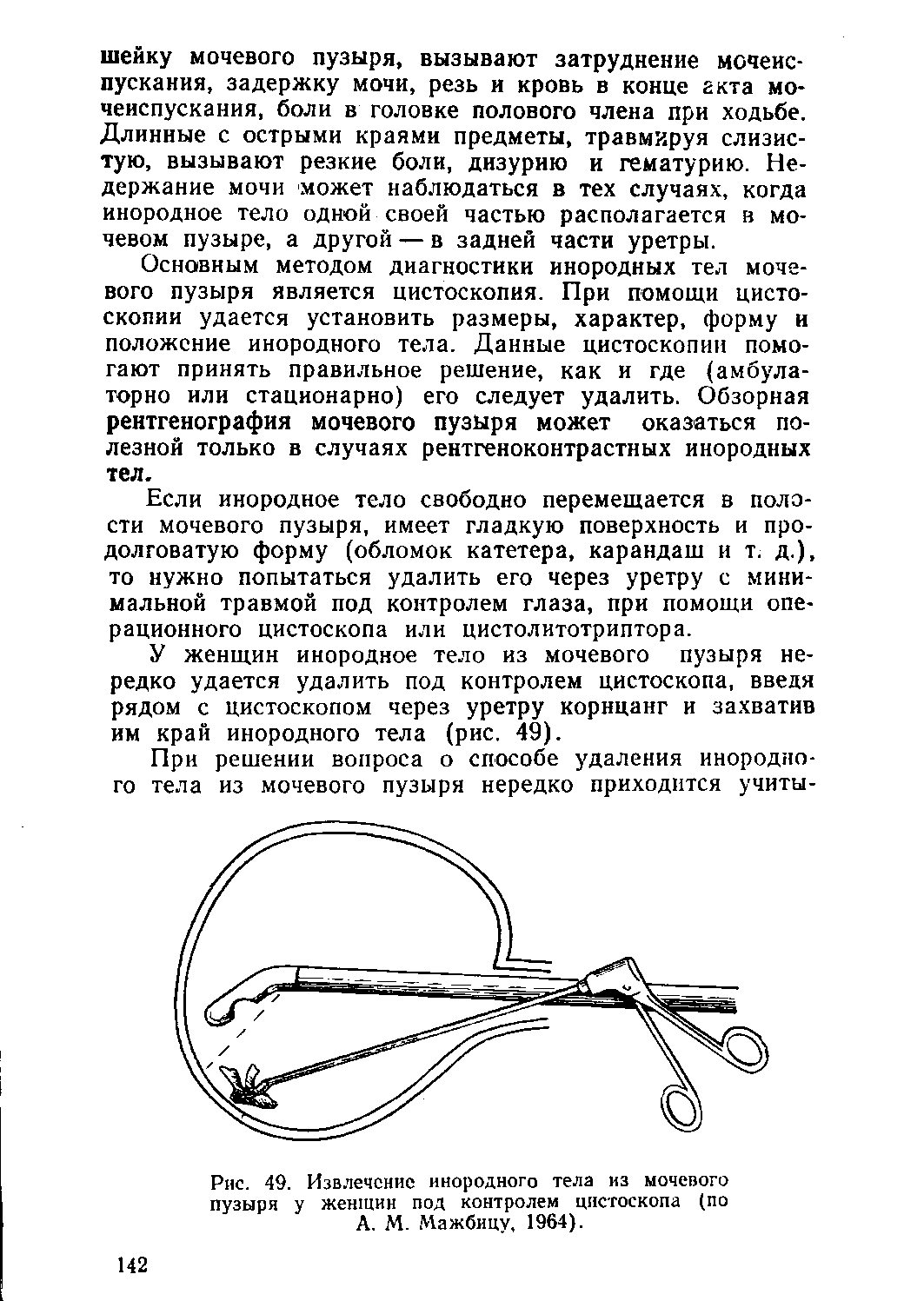 Рис. 49. Извлечение инородного тела из мочевого пузыря у женщин под контролем цистоскопа (по А. М. Мажбицу. 1964).