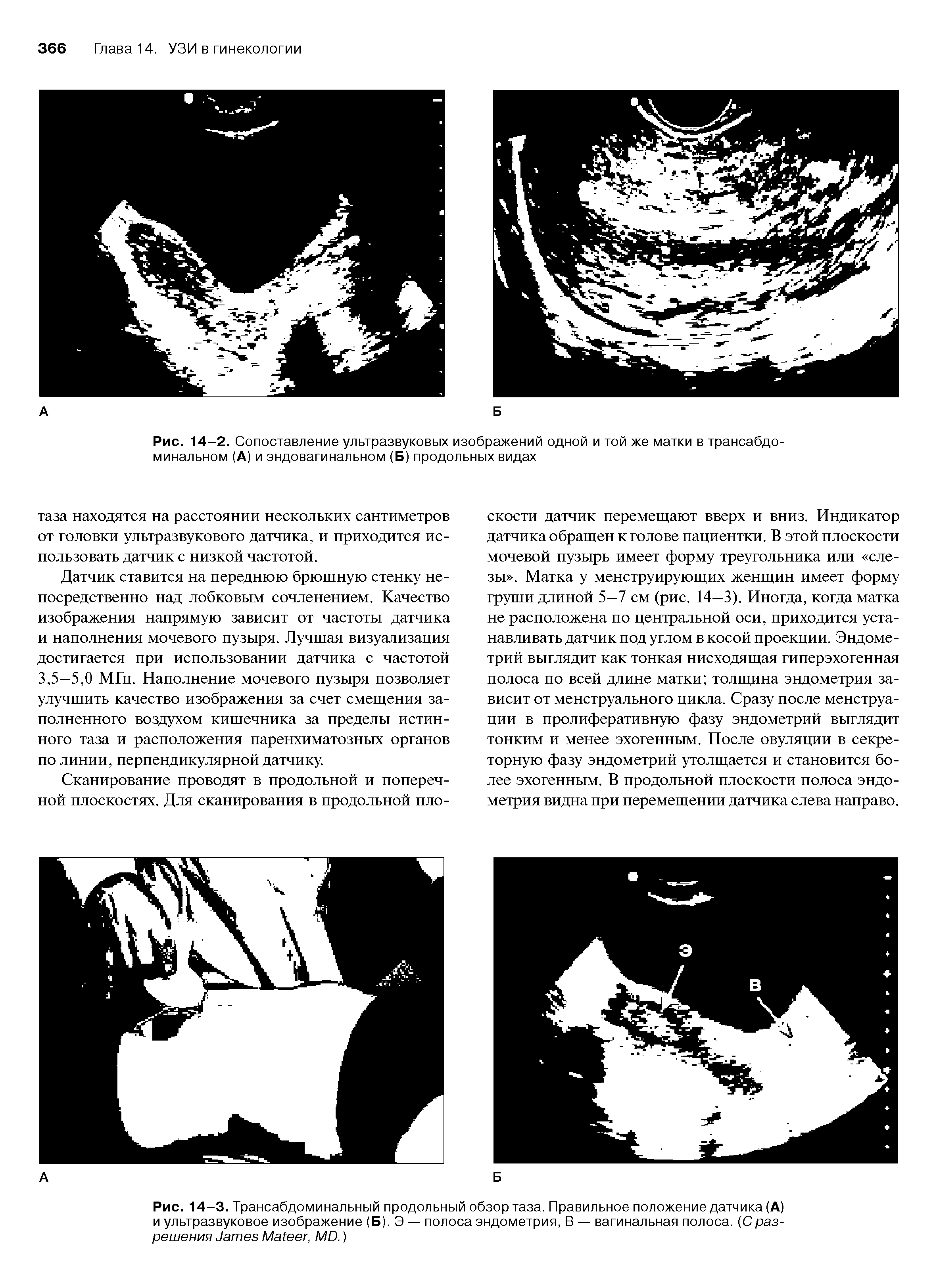 Рис. 14-3. Трансабдоминальный продольный обзор таза. Правильное положение датчика (А) и ультразвуковое изображение (Б). Э — полоса эндометрия, В — вагинальная полоса. (Сразрешения тев Ма(еег МО.)...