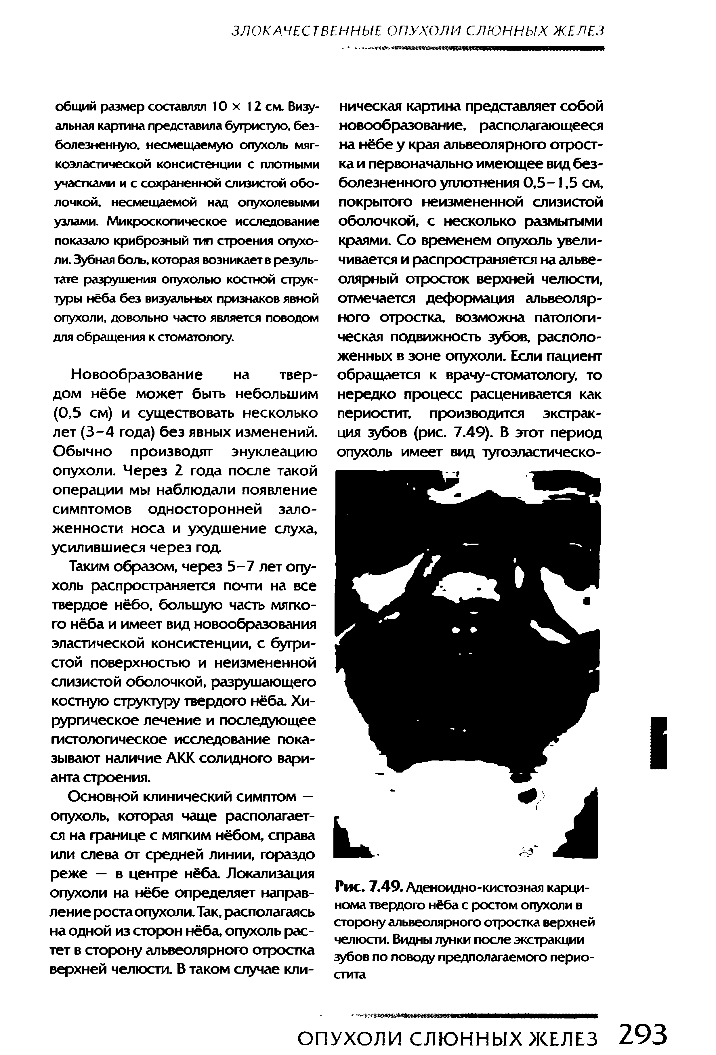 Рис. 7.49. Аденоидно-кистозная карцинома твердого нёба с ростом опухоли в сторону альвеолярного отростка верхней челюсти. Видны лунки после экстракции зубов по поводу предполагаемого периостита...