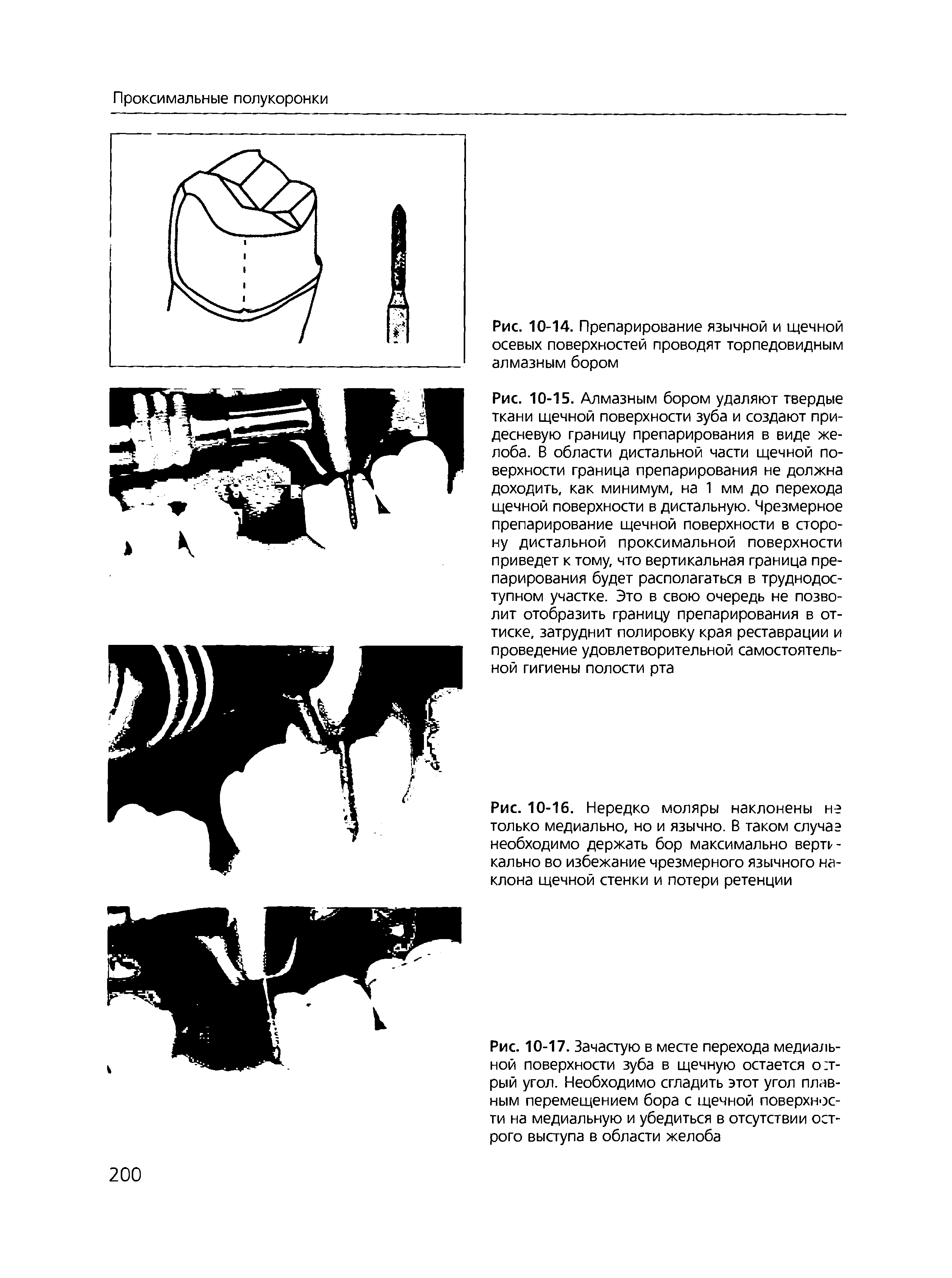 Рис. 10-16. Нередко моляры наклонены не только медиально, но и язычно. В таком случаэ необходимо держать бор максимально вертг-кально во избежание чрезмерного язычного наклона щечной стенки и потери ретенции...