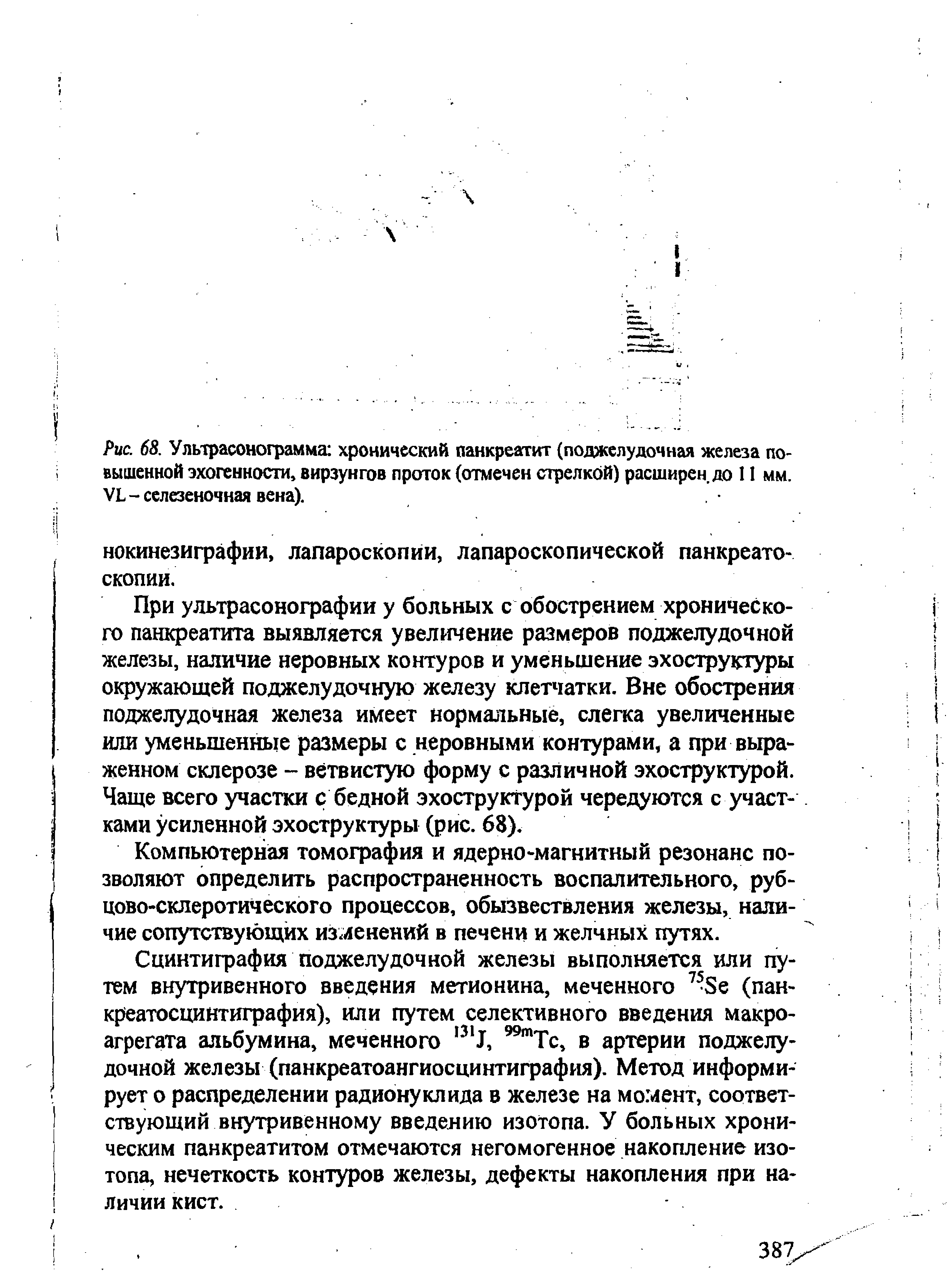 Рис. 68. Ультрасонограмма хронический панкреатит (поджелудочная железа повышенной эхогенности, вирзунгов проток (отмечен стрелкой) расширен, до 11 мм. УЬ - селезеночная вена).