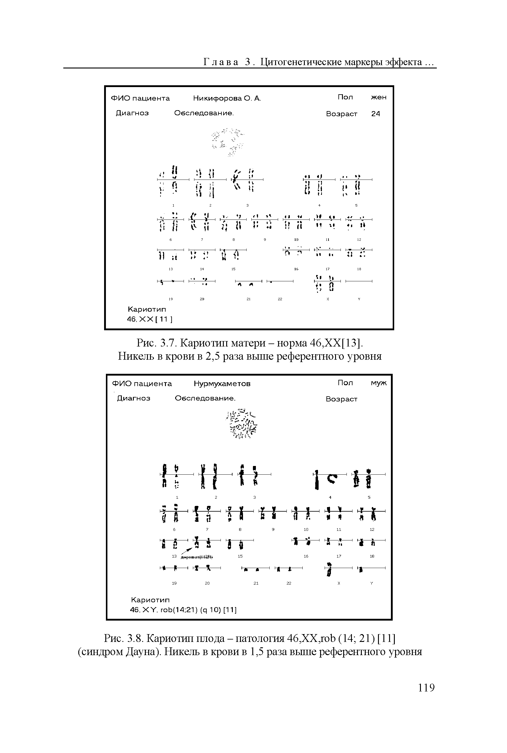 Рис. 3.8. Кариотип плода - патология 46,ХХ,гоЬ (14 21) [11] (синдром Дауна). Никель в крови в 1,5 раза выше референтного уровня...