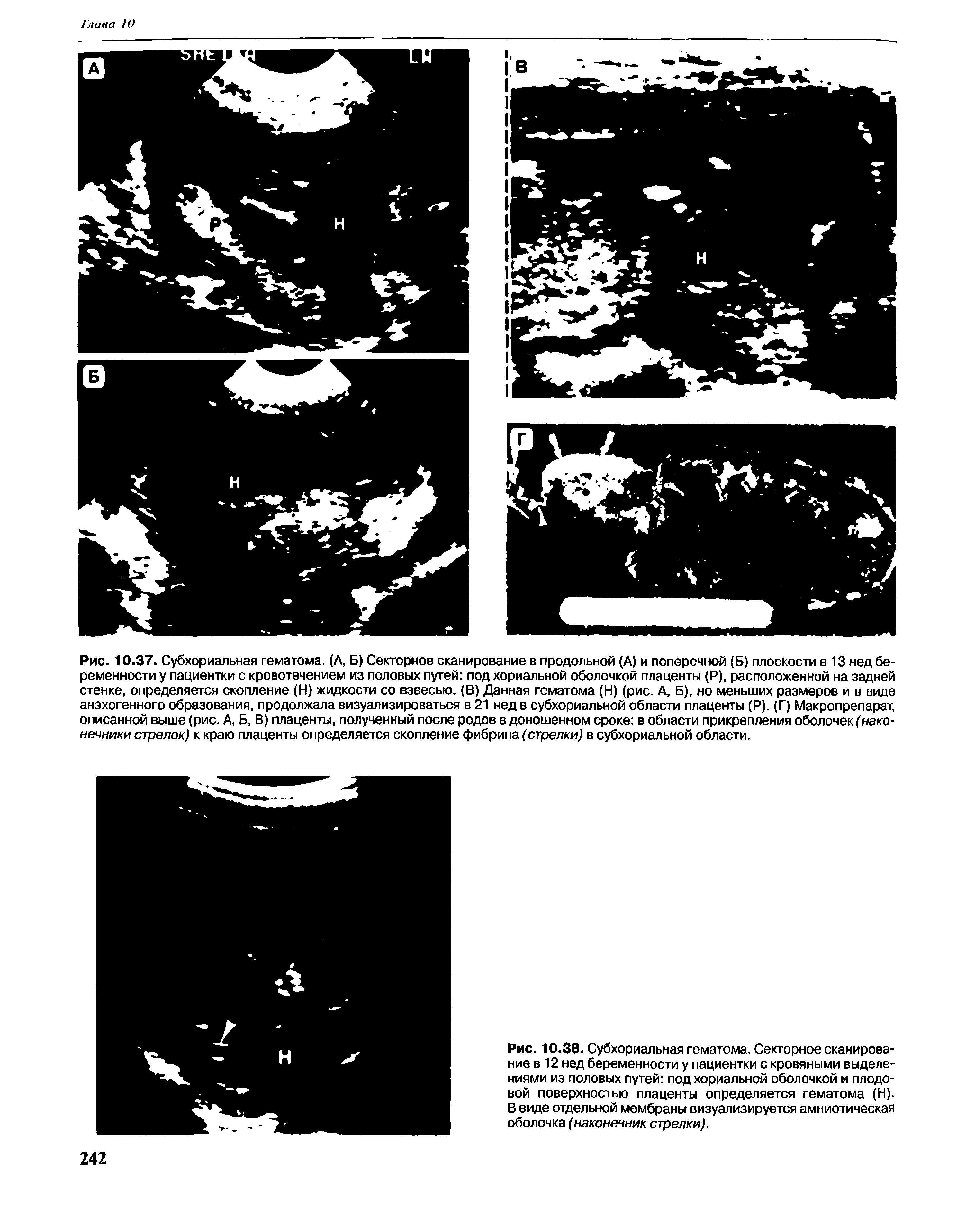 Рис. 10.38. Субхориальная гематома. Секторное сканирование в 12 нед беременности у пациентки с кровяными выделениями из половых путей под хориальной оболочкой и плодовой поверхностью плаценты определяется гематома (Н). В виде отдельной мембраны визуализируется амниотическая оболочка (наконечник стрелки).