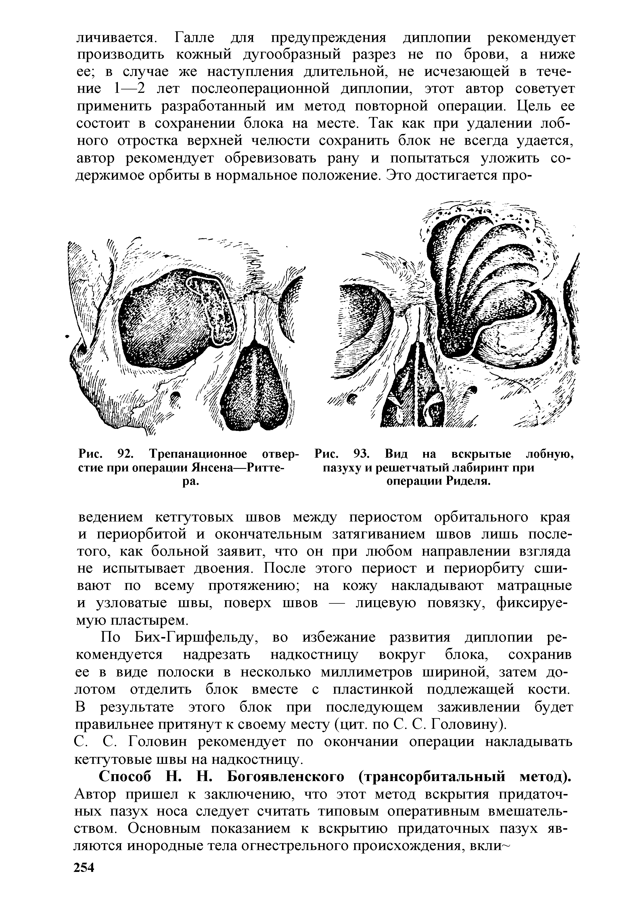 Рис. 93. Вид на вскрытые лобную, пазуху и решетчатый лабиринт при операции Риделя.