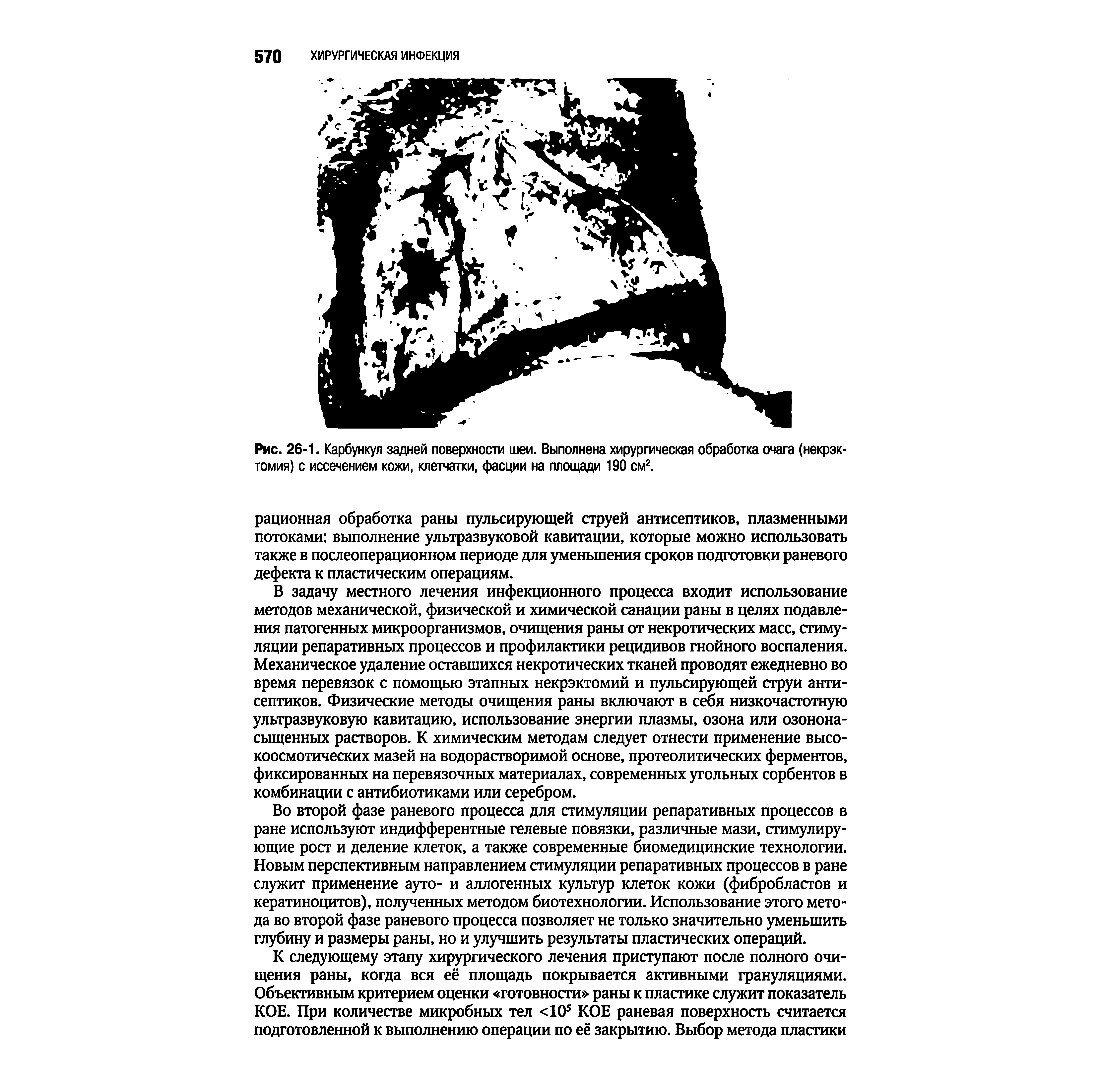 Рис. 26-1. Карбункул задней поверхности шеи. Выполнена хирургическая обработка очага (некрэк-томия) с иссечением кожи, клетчатки, фасции на площади 190 см2.